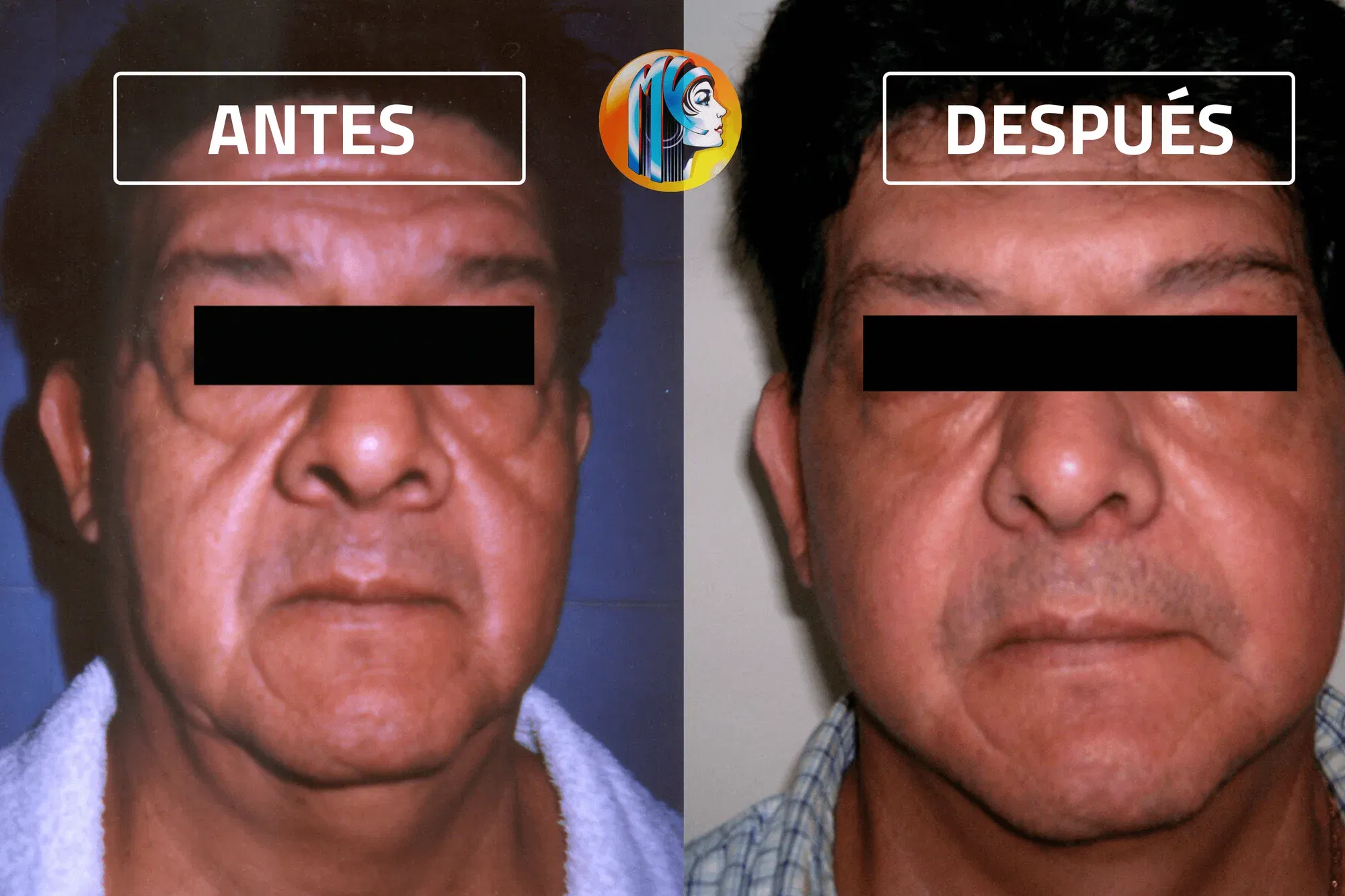 LIFTING FACIAL Clínica De Cirugía Plástica Vera Mogro