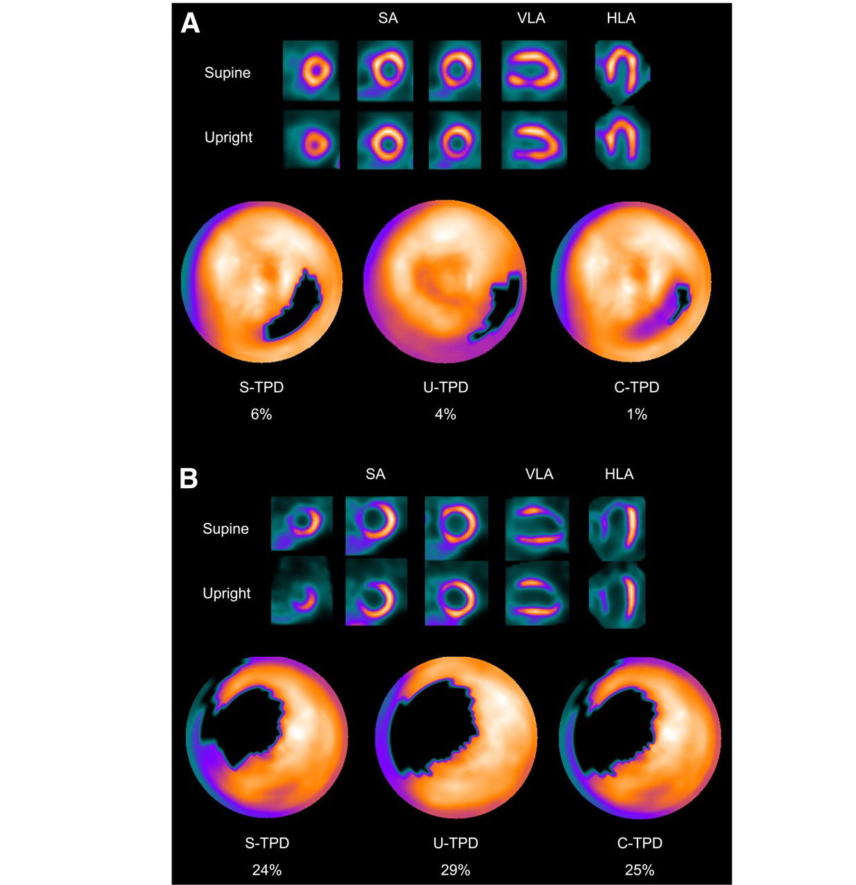 myocardial-perfusion-imaging