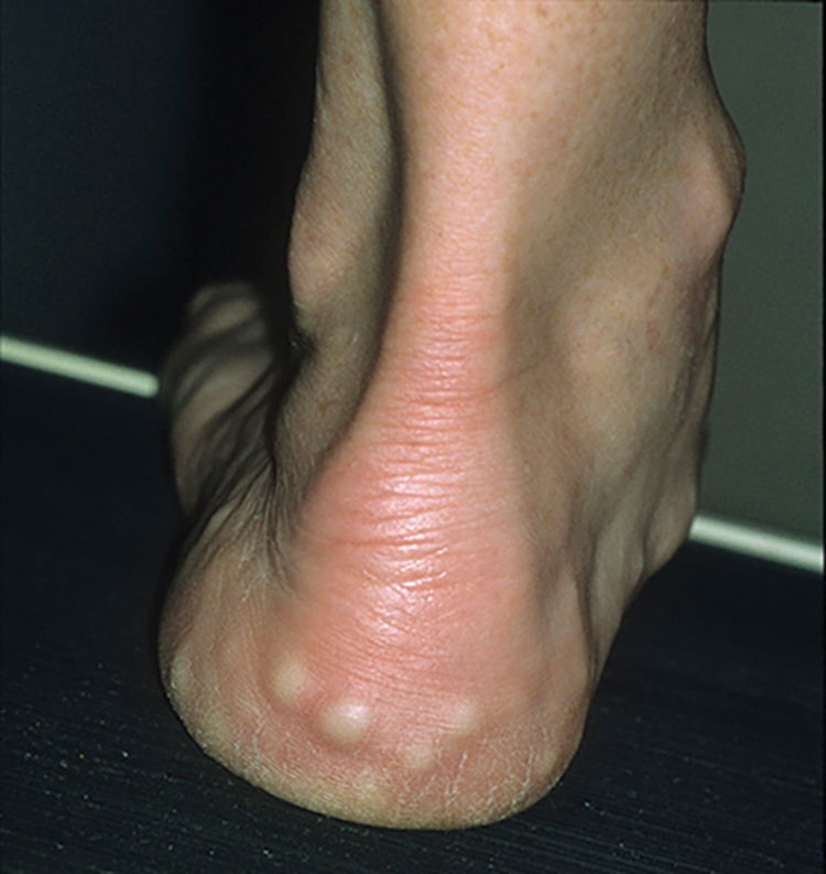 sides of feet itch