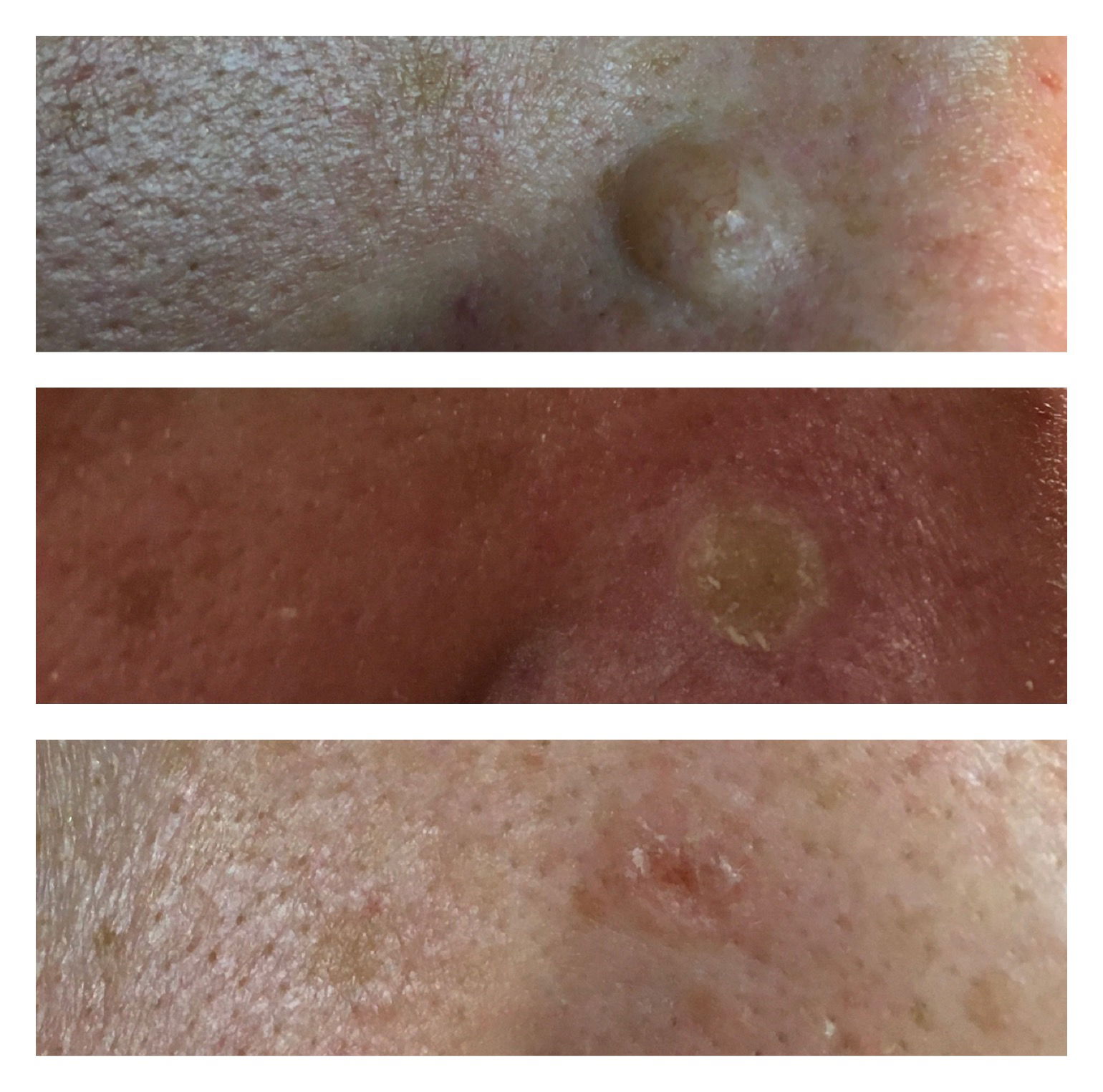 skin deep electrolysis skin deep electrolysis