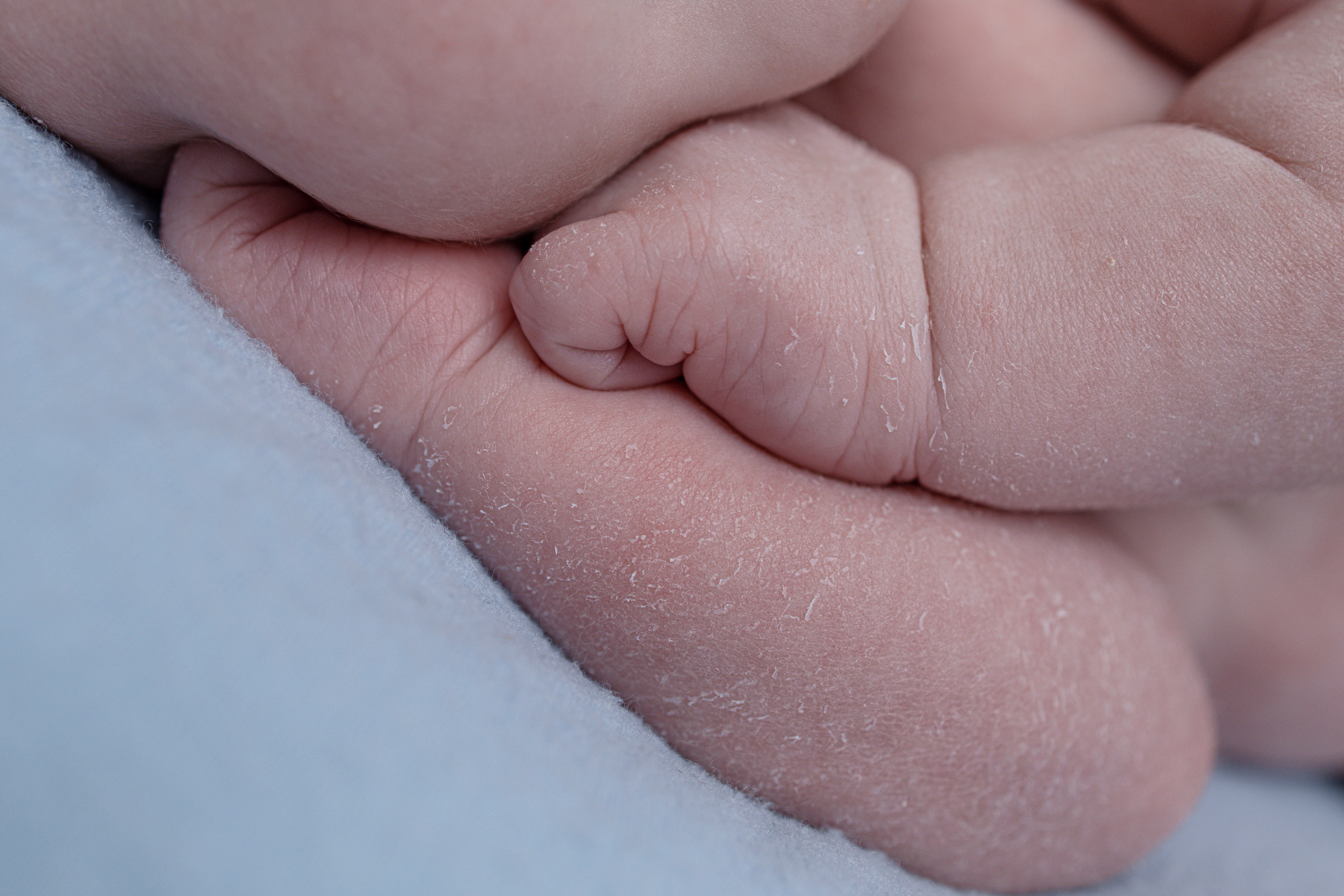 petites peaux qui pèlent sur un nouveau-né