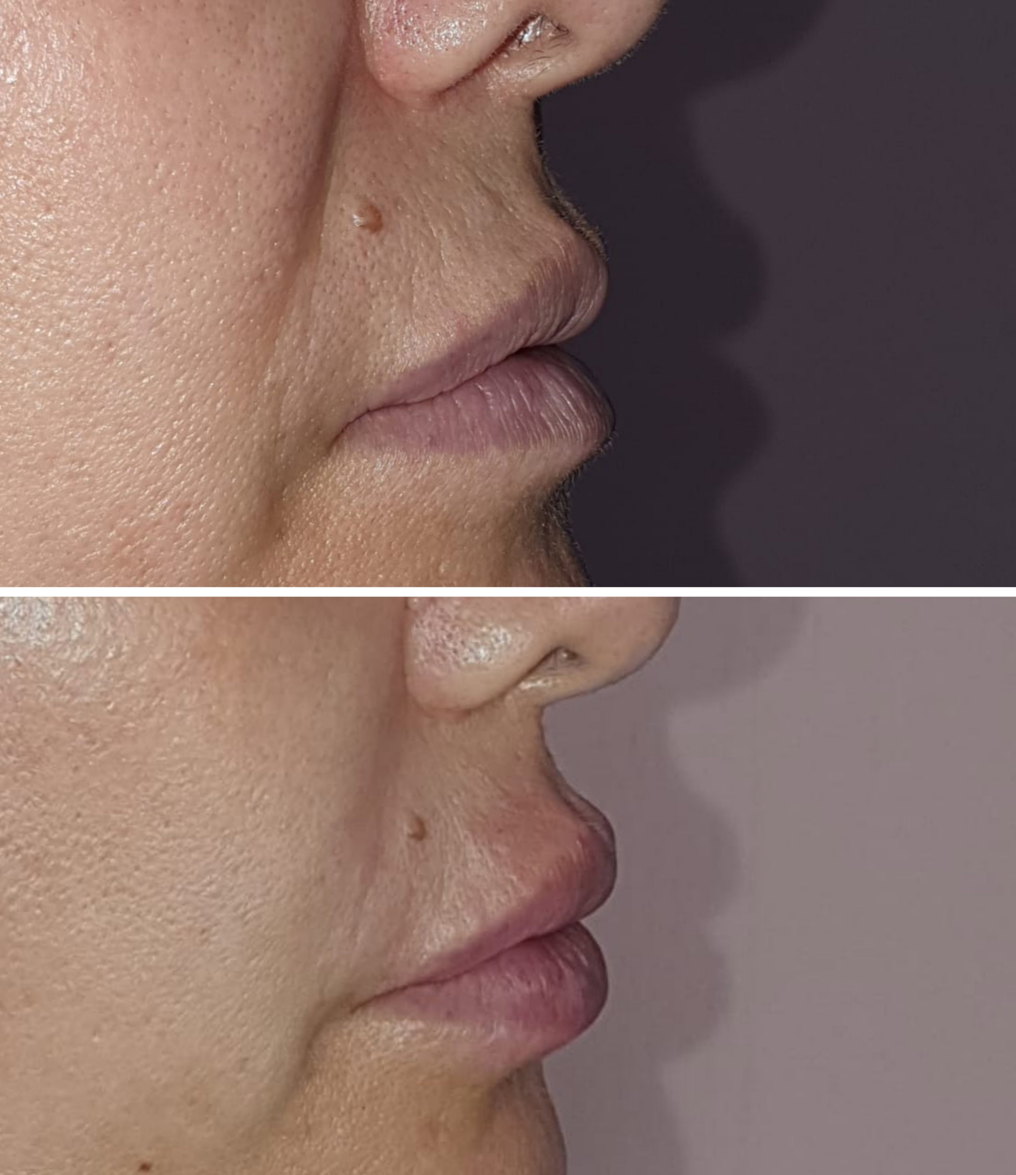 Rellenos (Ácido Hialurónico)