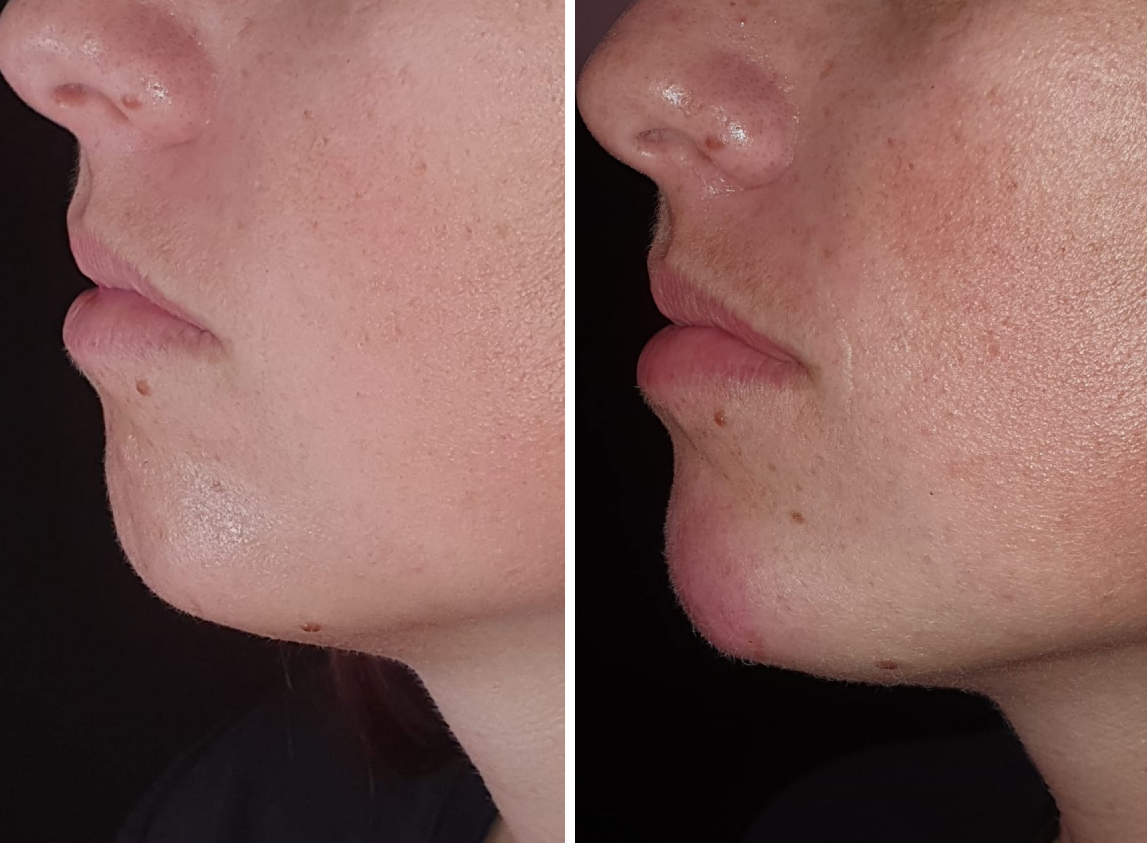 Rellenos (Ácido Hialurónico)