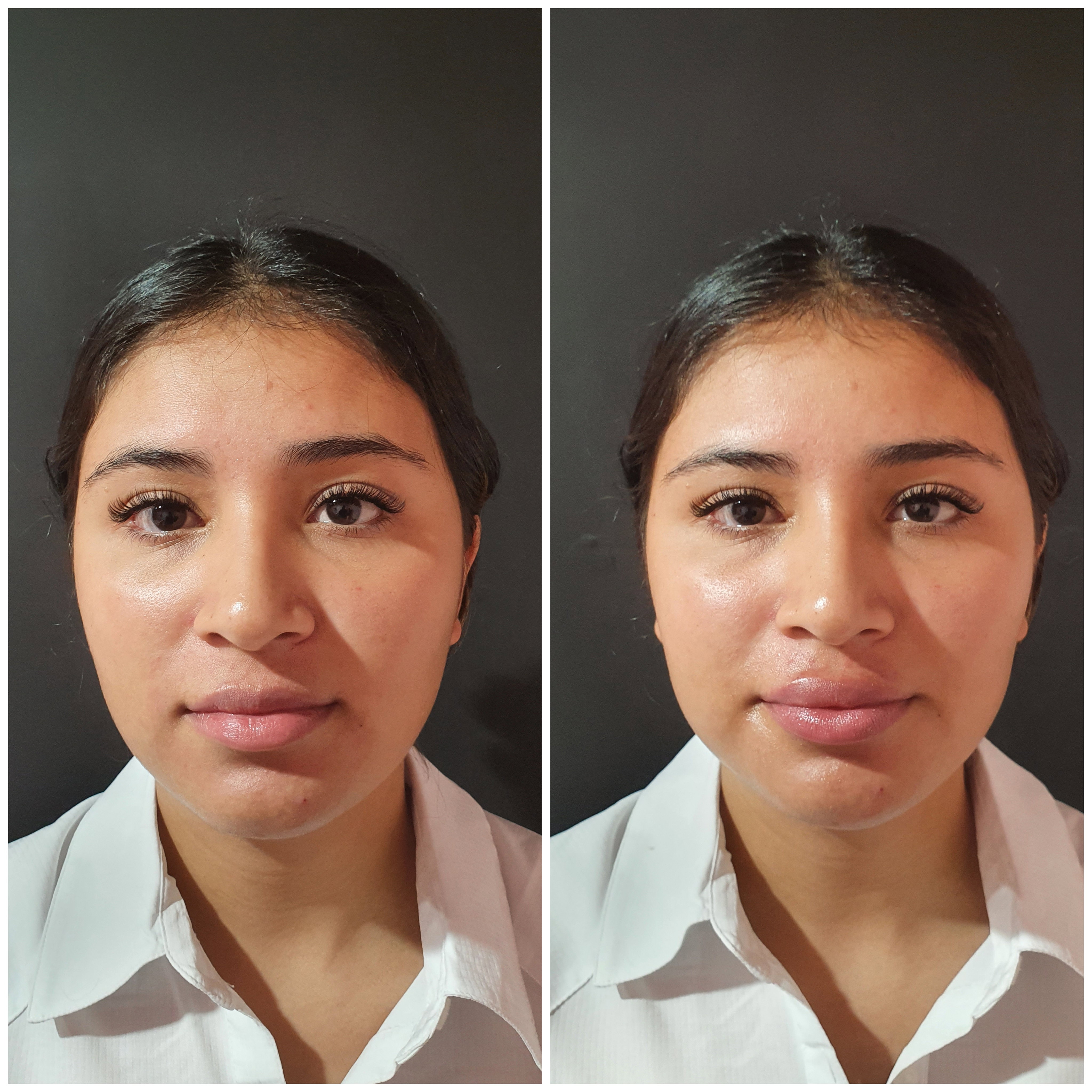 Rellenos (Ácido Hialurónico)