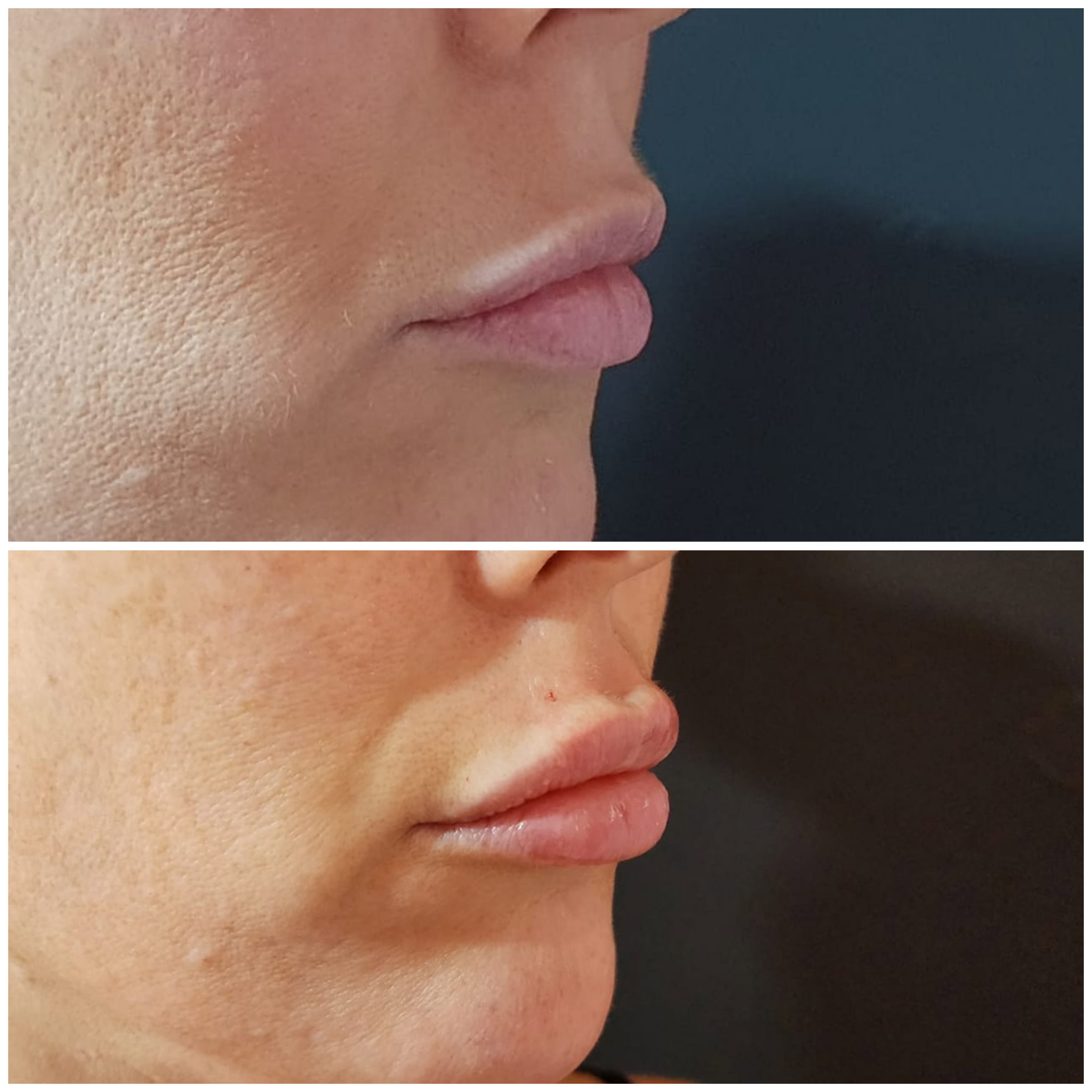 Rellenos (Ácido Hialurónico)