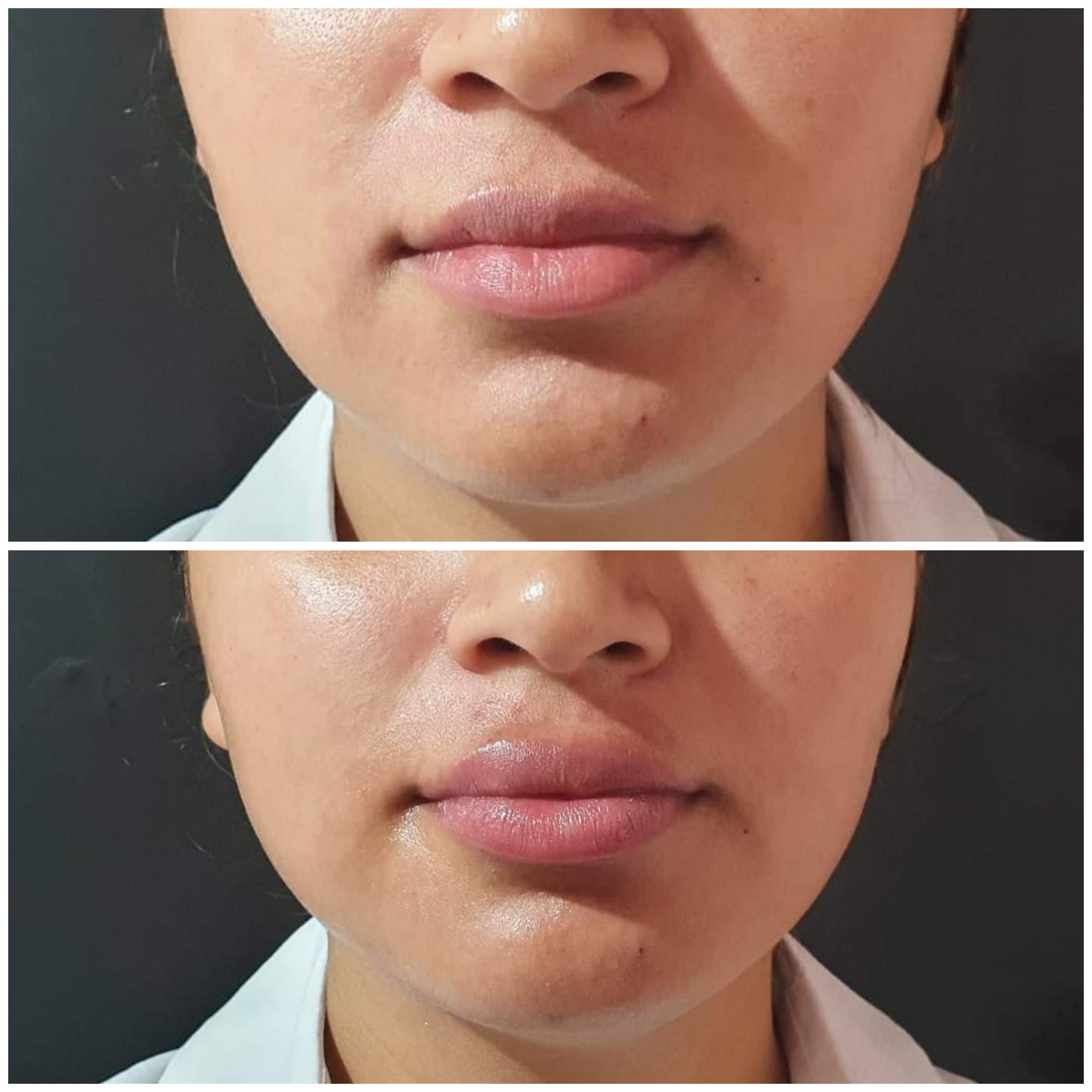 Rellenos (Ácido Hialurónico)