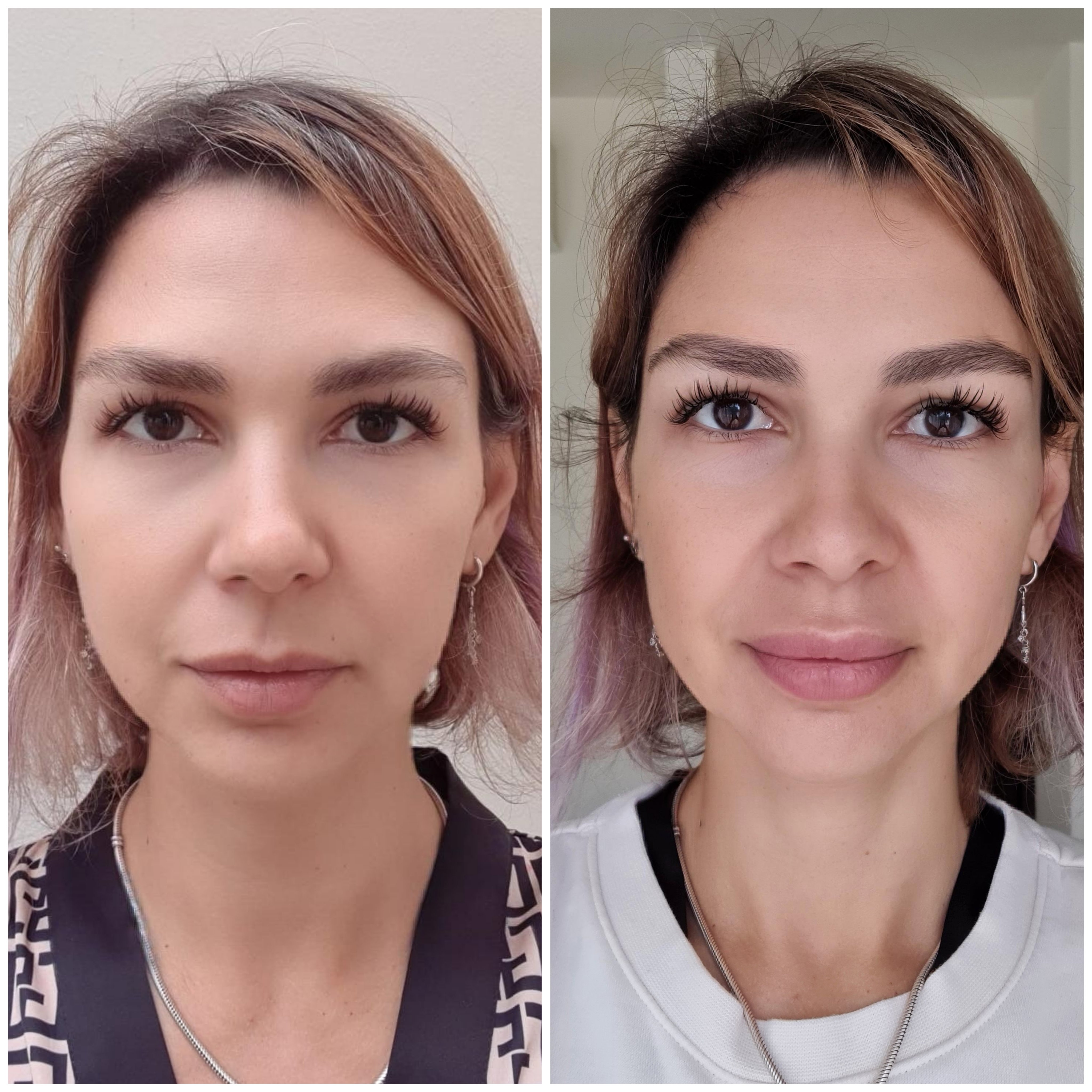 Rellenos (Ácido Hialurónico)