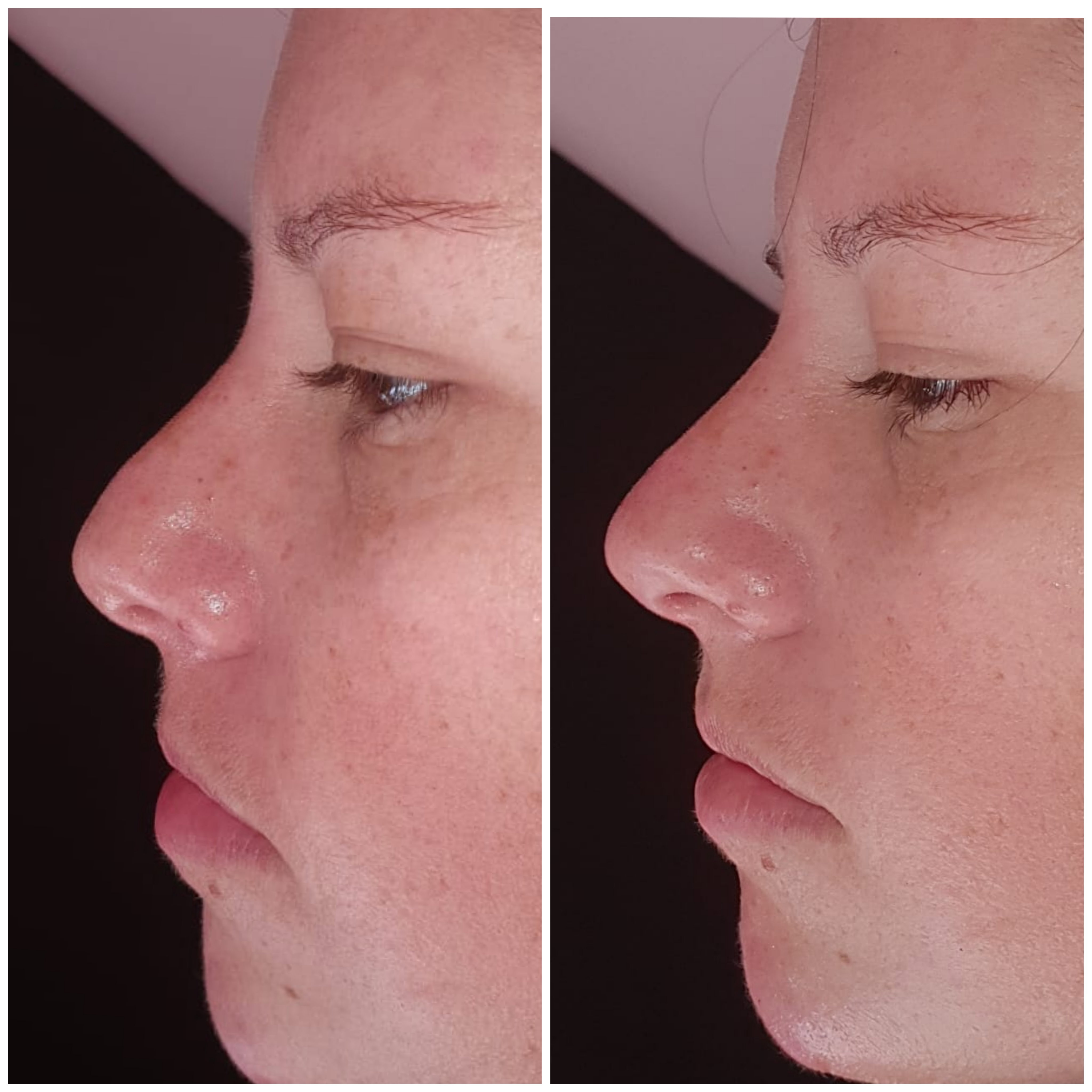 Rellenos (Ácido Hialurónico)