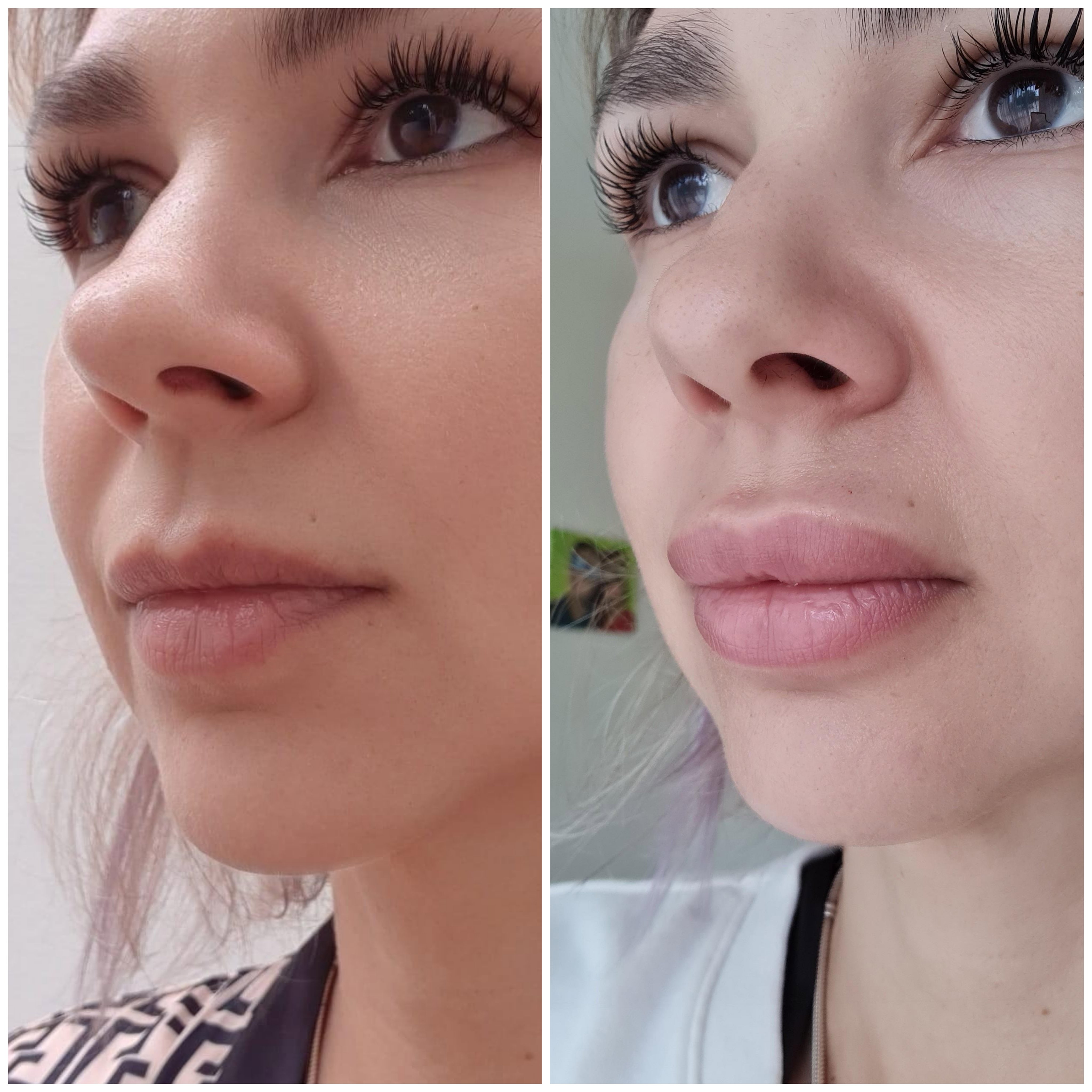 Rellenos (Ácido Hialurónico)