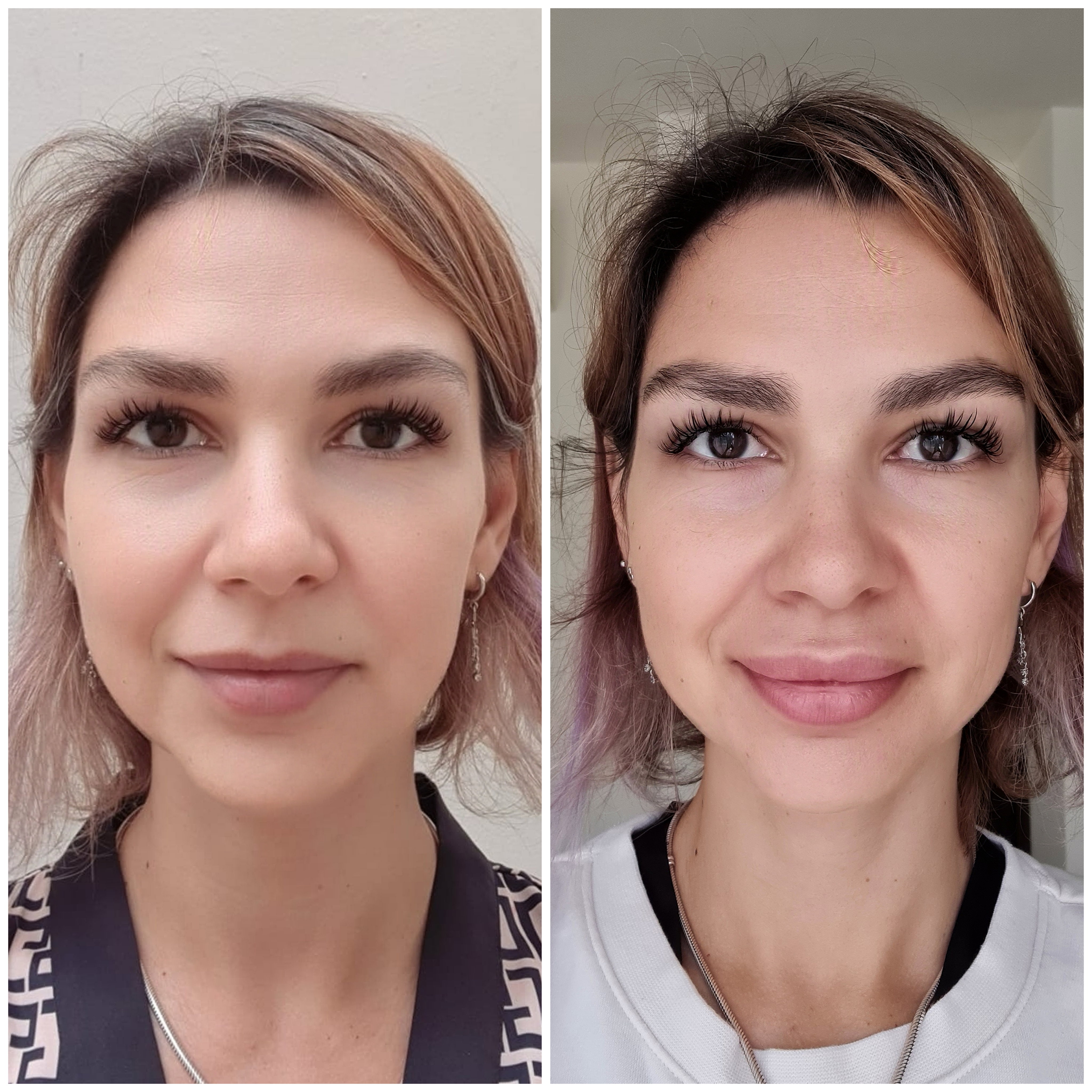 Rellenos (Ácido Hialurónico)