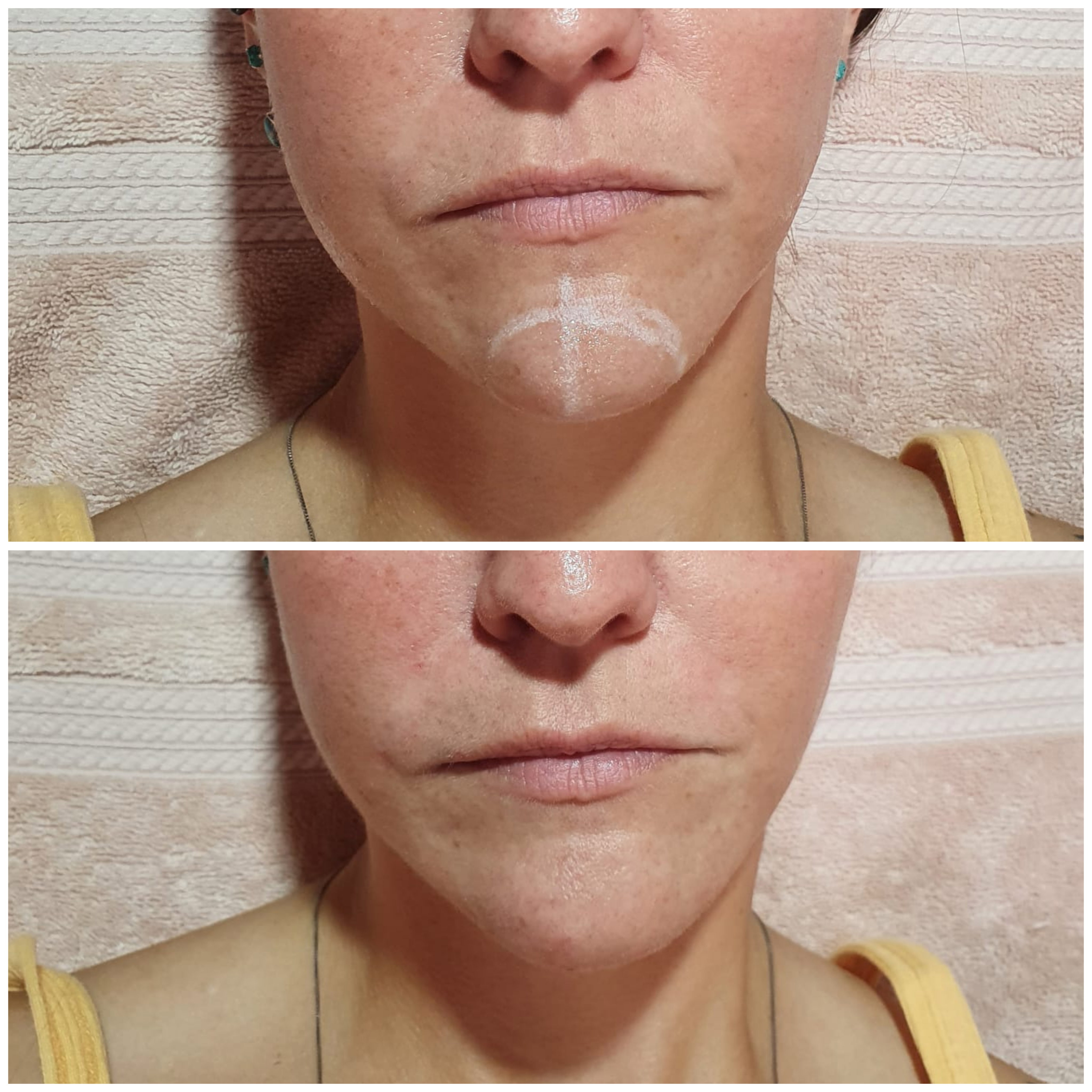 Rellenos (Ácido Hialurónico)