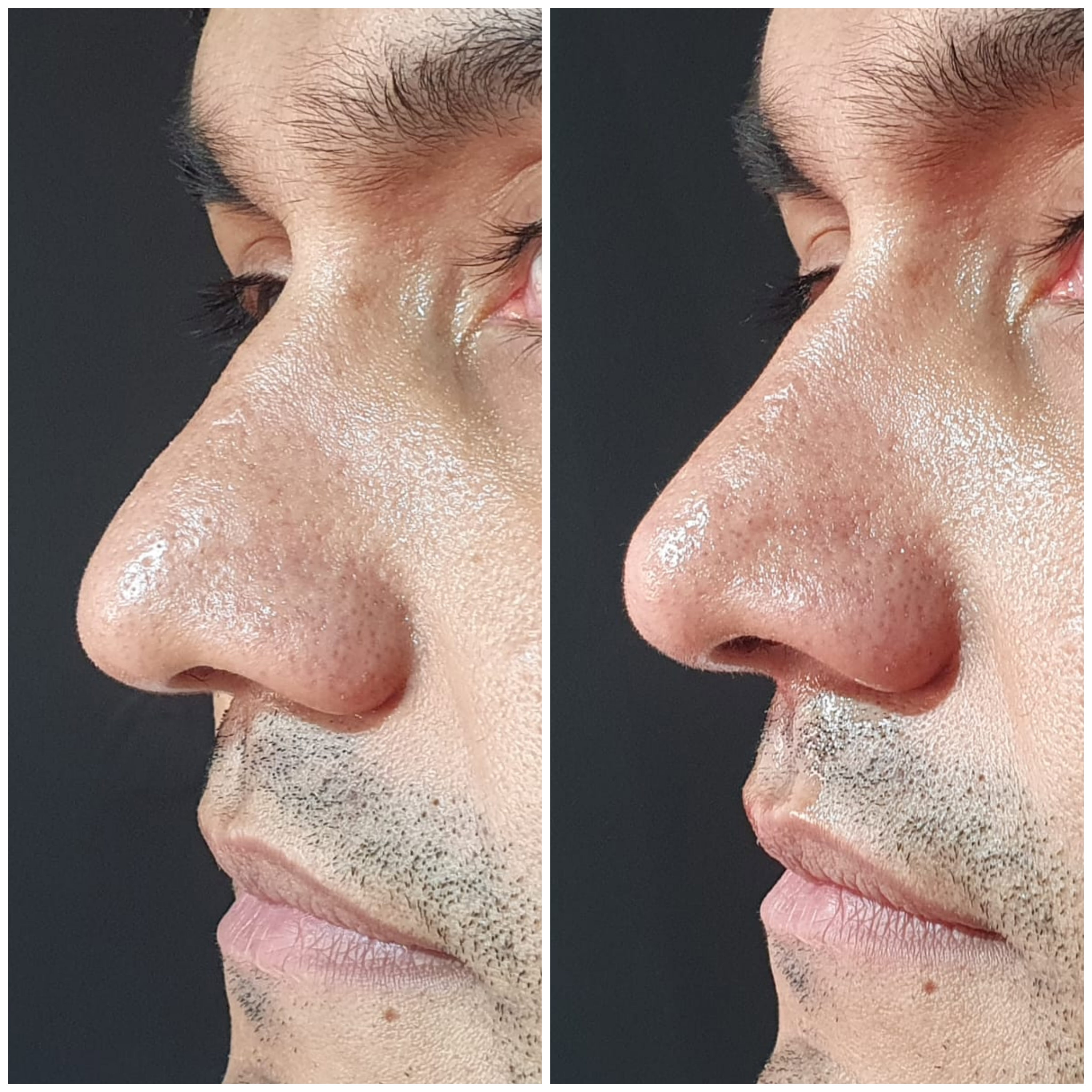 Rellenos (Ácido Hialurónico)