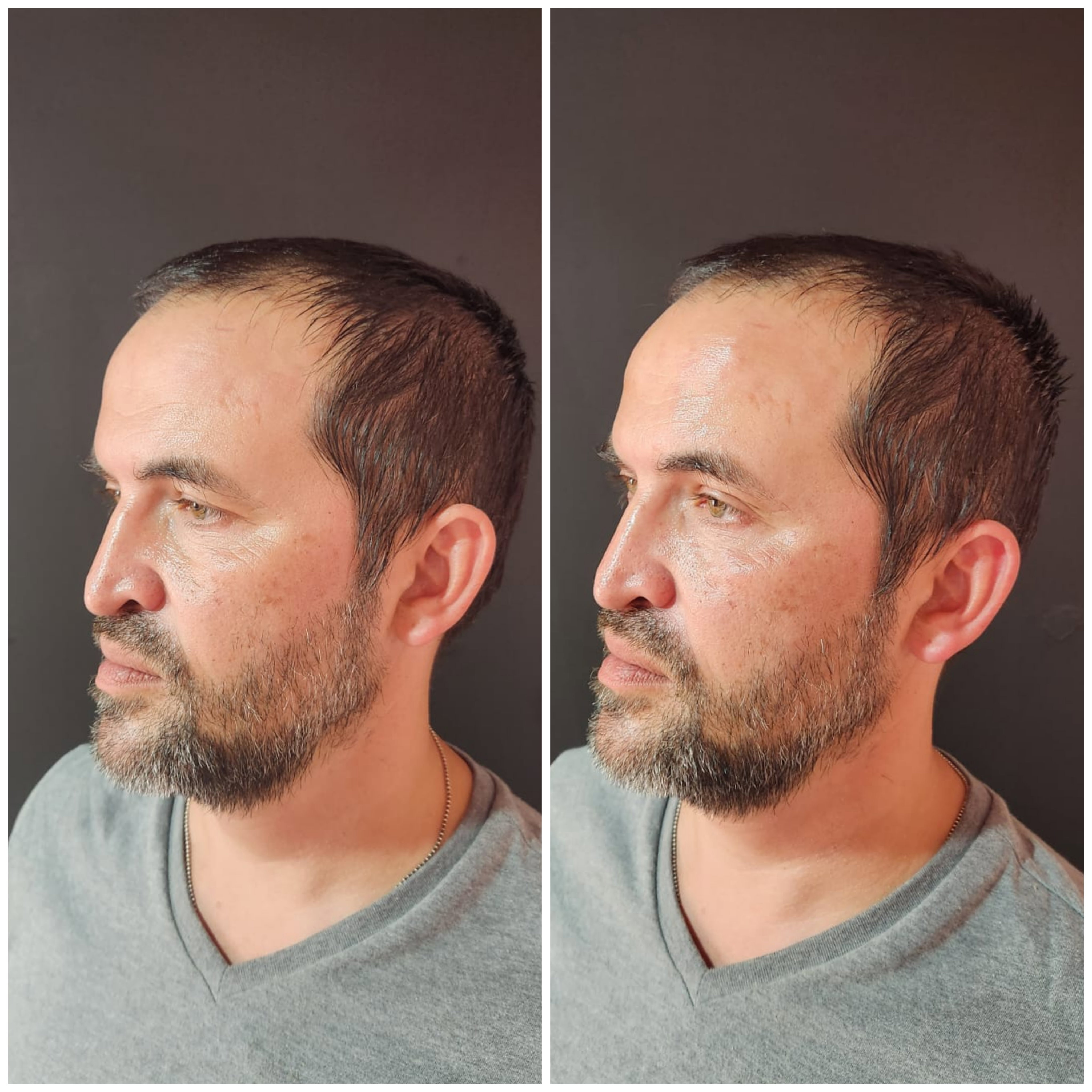 Rellenos (Ácido Hialurónico)