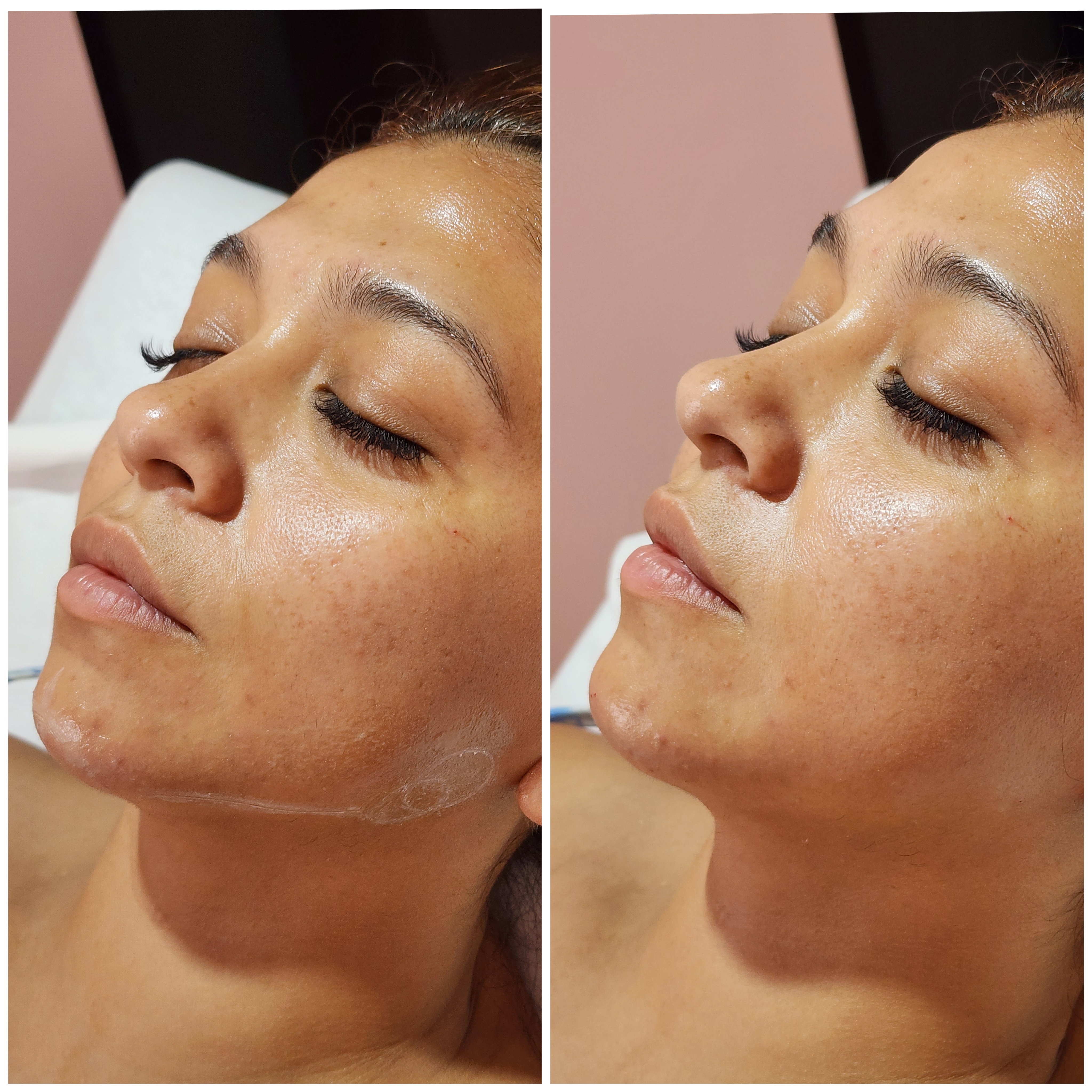 Rellenos (Ácido Hialurónico)