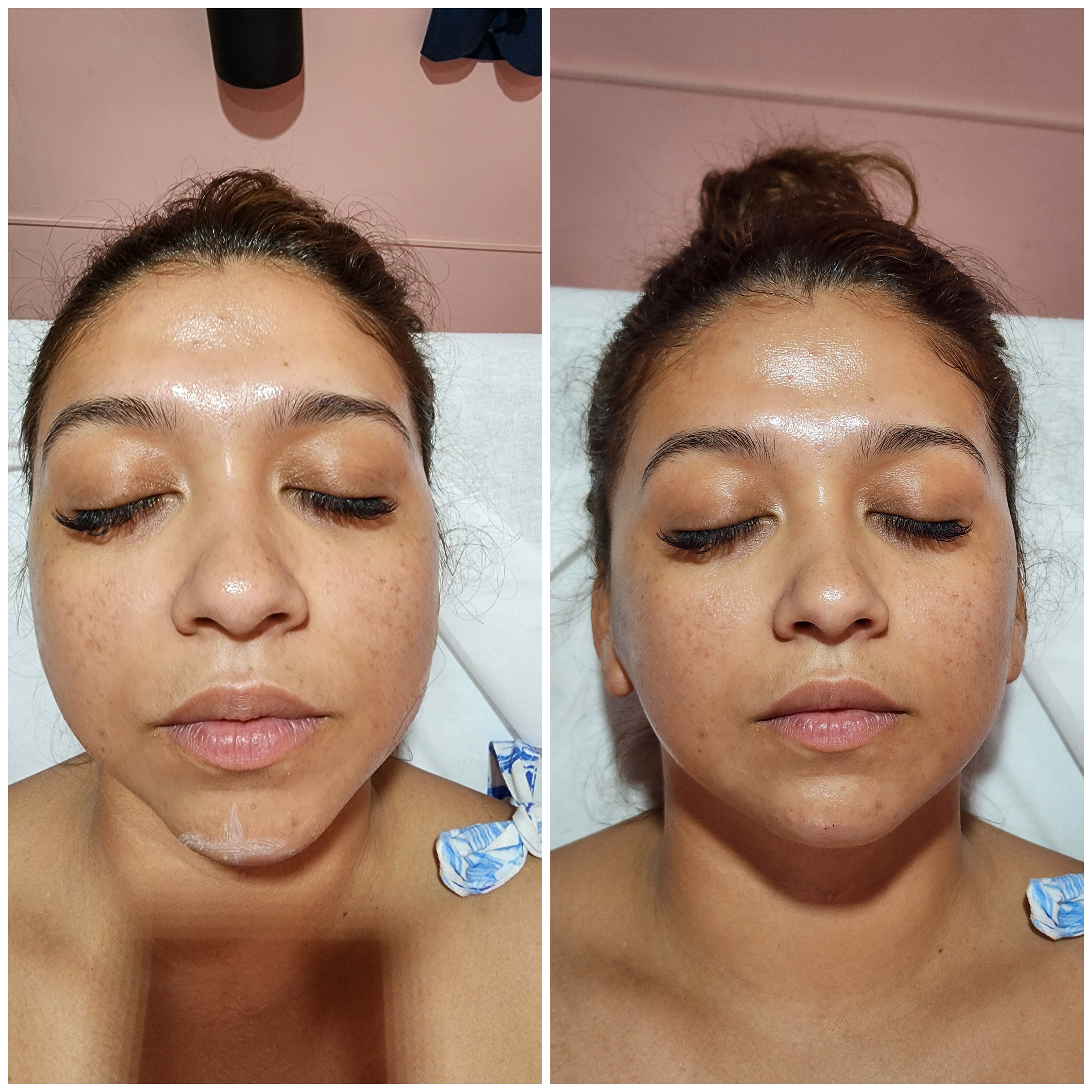 Rellenos (Ácido Hialurónico)