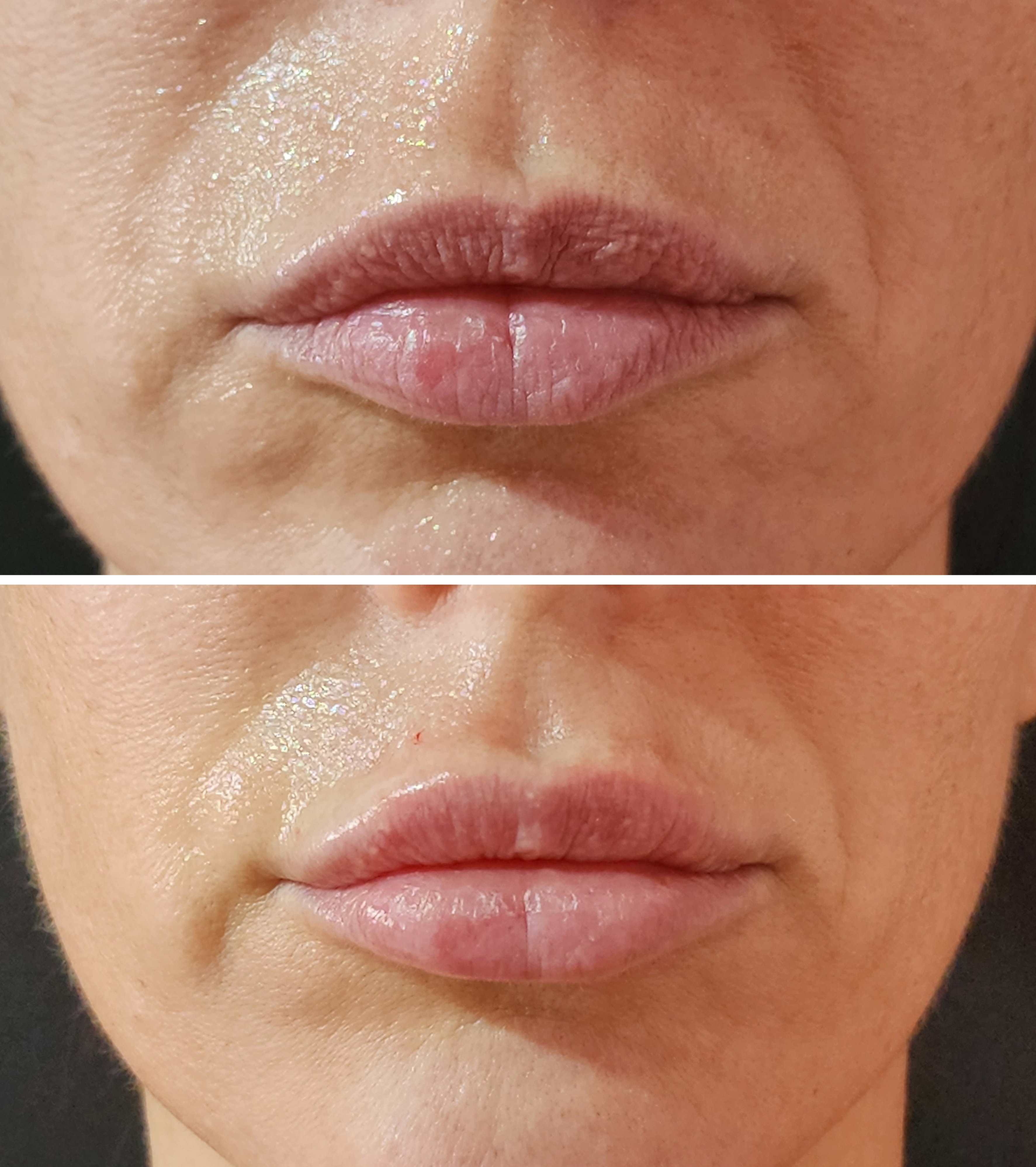 Rellenos (Ácido Hialurónico)