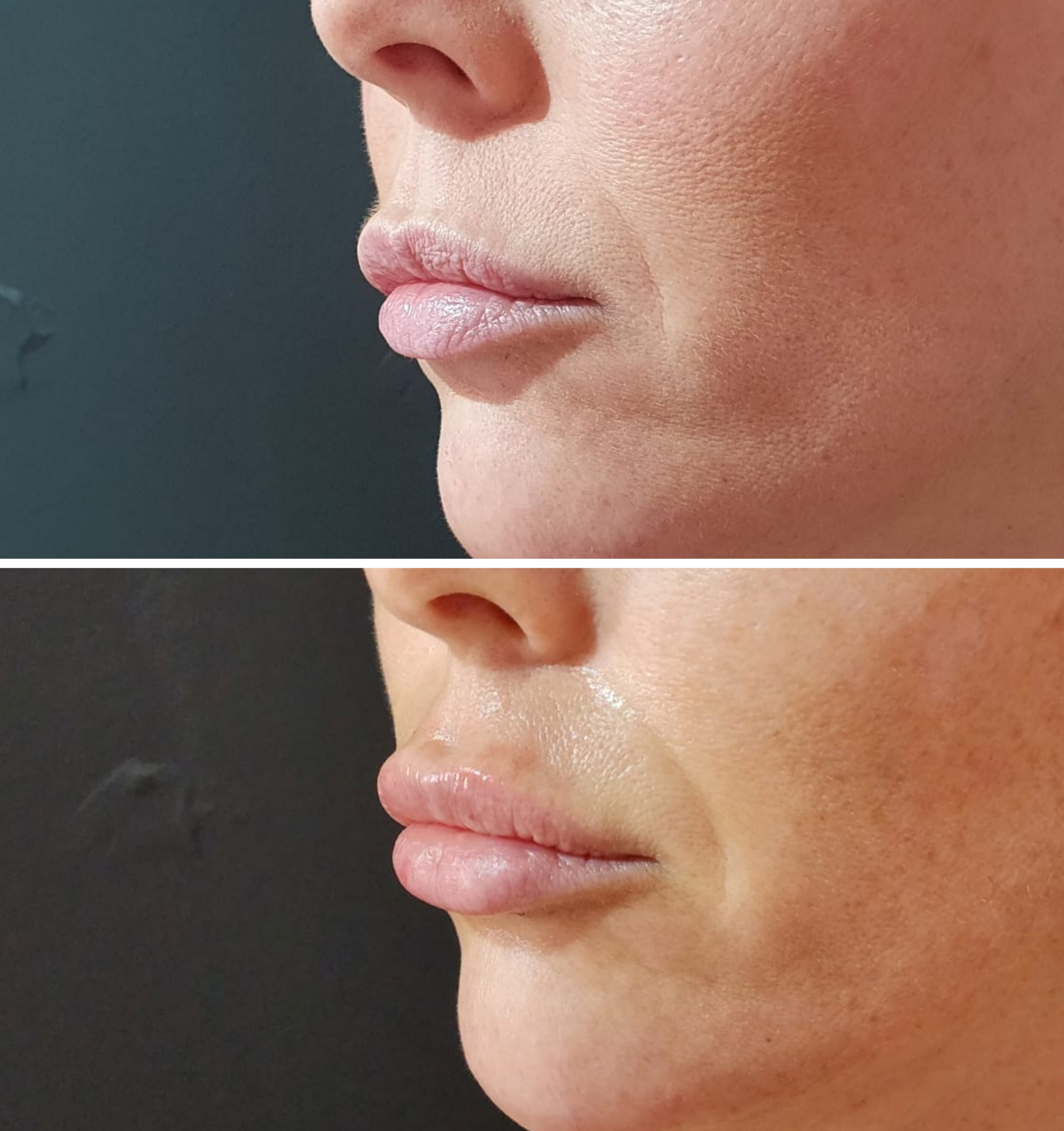 Rellenos (Ácido Hialurónico)