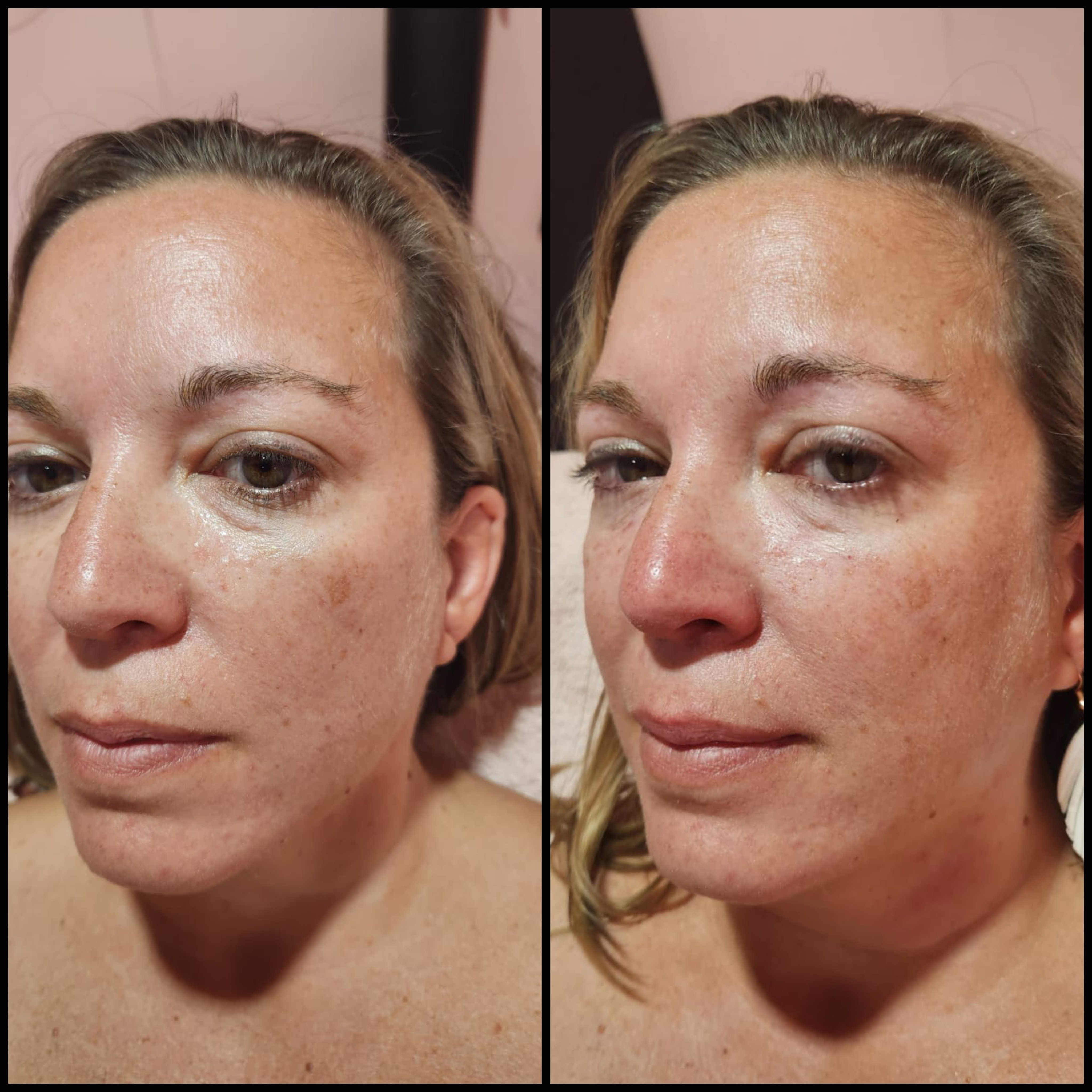 Rellenos (Ácido Hialurónico)