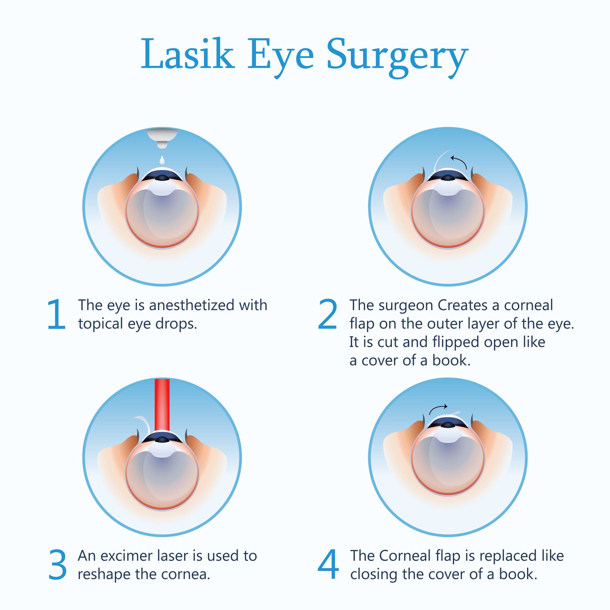 Refractive Surgery - Visalia Eye Center