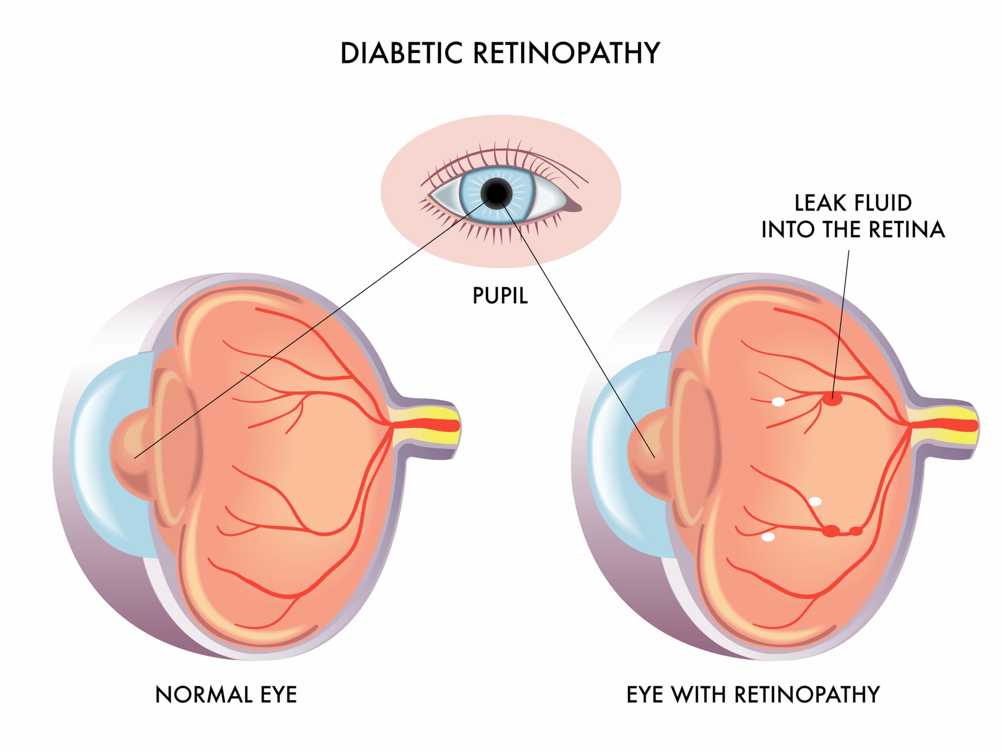 Medical Retina Visalia Eye Center