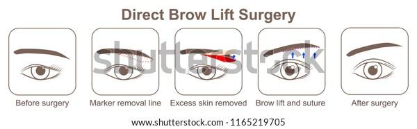 Direct Brow Lift Surgery