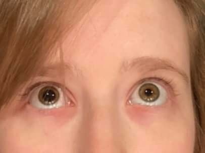 Photo of Katie's Eyes - the right pupil is non-responsive to light and the left pupil is normal.