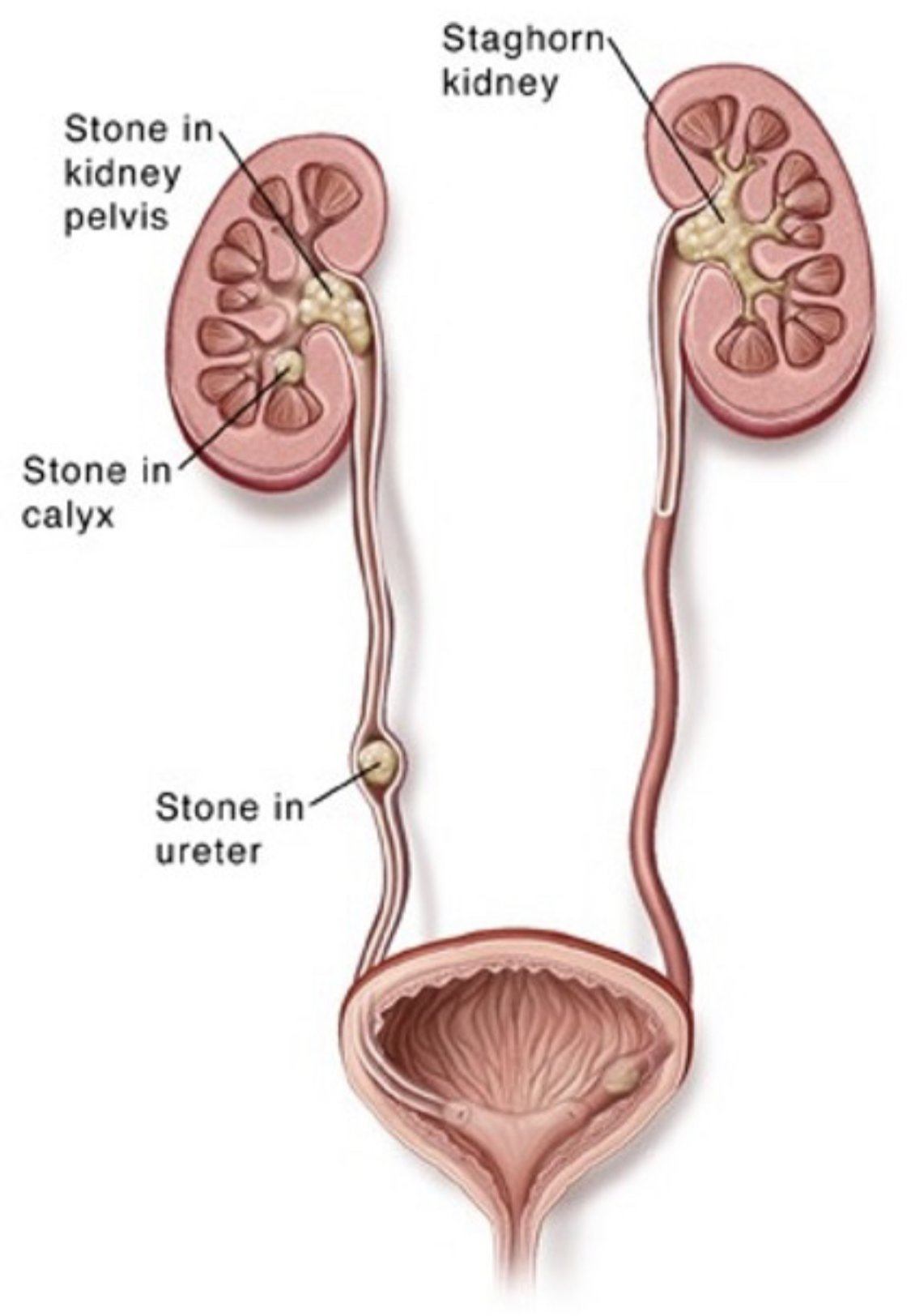 kidney-stones-treatment-and-prevention-aafp