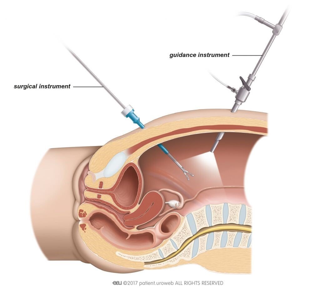 Fig. 2: For laparoscopic surgery the surgeon inserts the surgical instruments through small incisions in the abdomen.