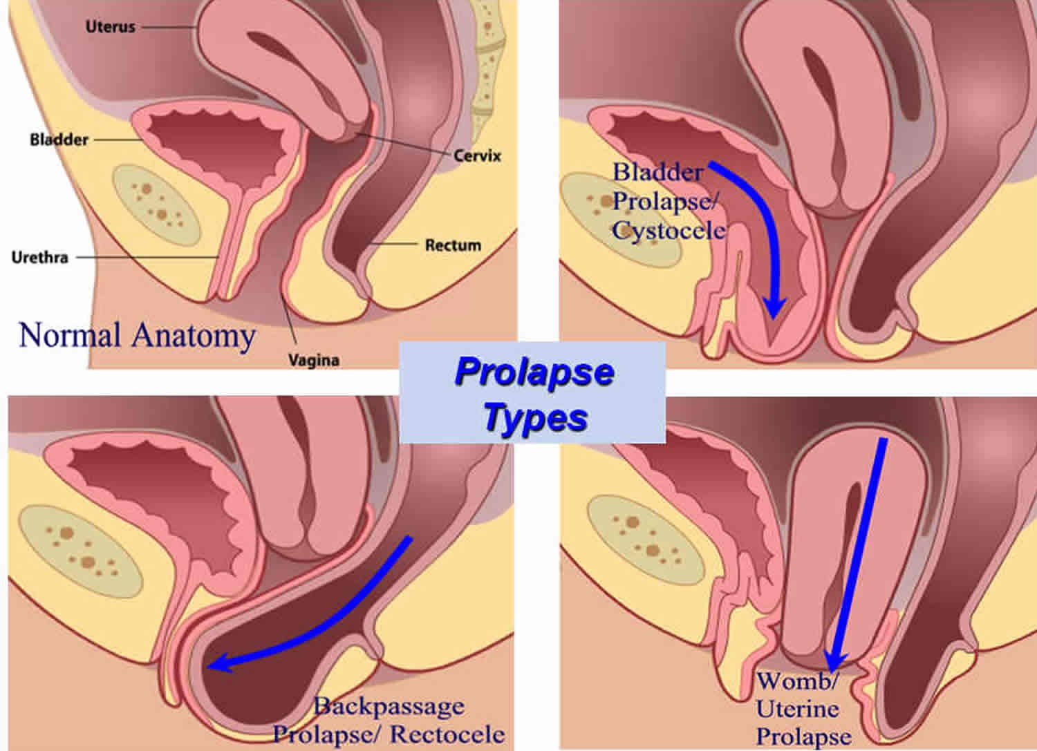 What is Pelvic Organ Prolapse?  Types of Prolapse, Diagnosis, Treatment