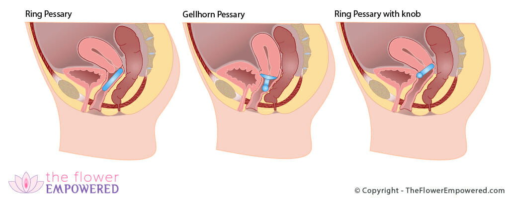 Pelvic Organ Prolapse Surgery