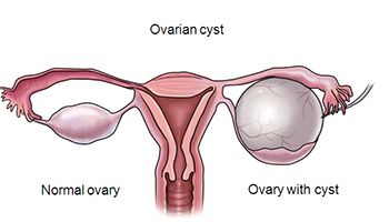 An ovarian cyst is a fluid-filled sac that forms on or within an ovary.  Ovarian cysts are quite common and often form during the menstrua