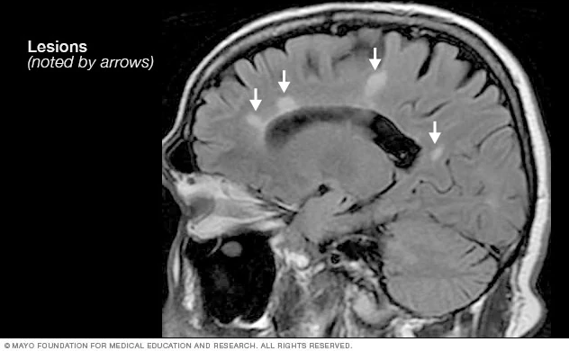 Brain MRI scan showing multiple sclerosis lesions