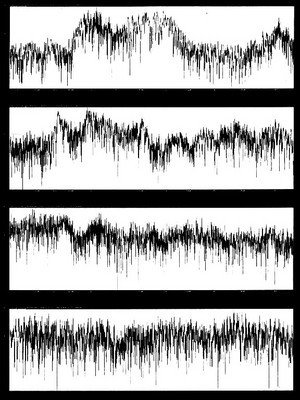 Illustration of the balance in a voice print over 4 BioWaves Sound Therapy Sessions.