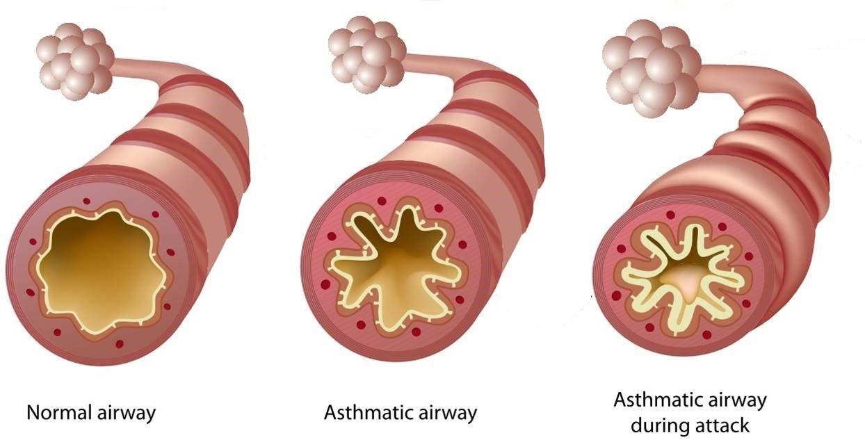 Asthma Attacks identify, recognise and respond. The First Aid