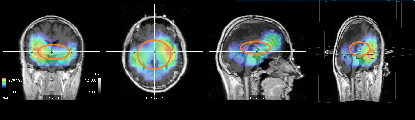 Gabriel-Technologie FR - Tests EEG - Effets sur le cerveau im01