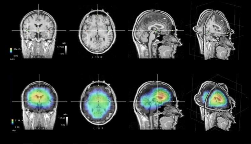 Gabriel-Technologie FR - Tests EEG - Effets sur le cerveau im05