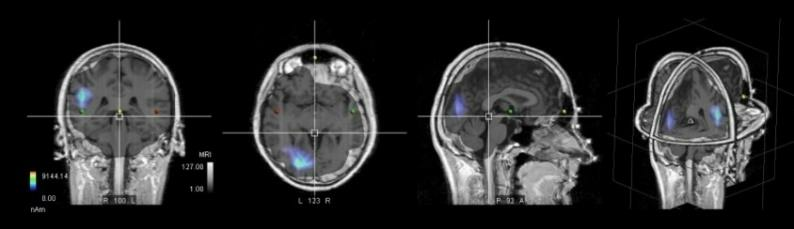 Gabriel-Technologie FR - Tests EEG - Effets sur le cerveau im06