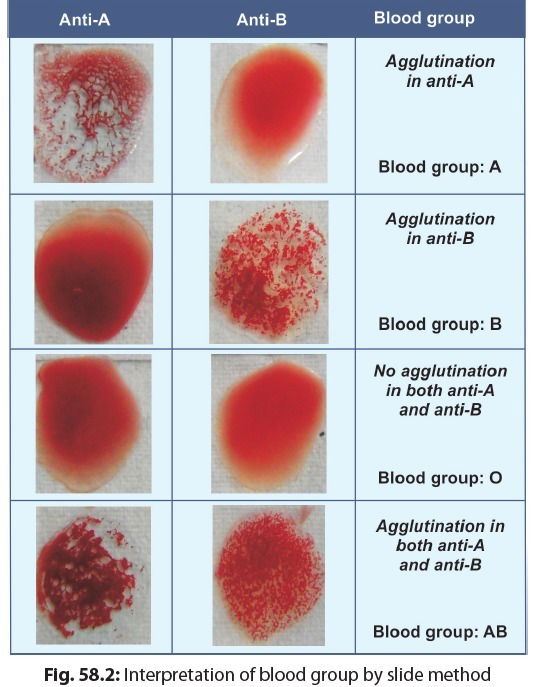 BLOOD GROUP SYSTEM 5