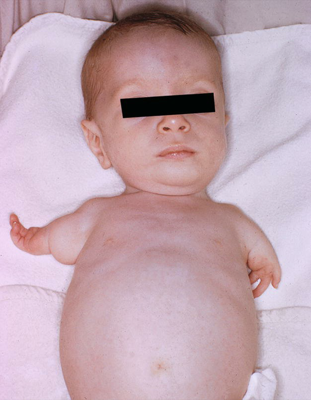 Upper Limb Development 2