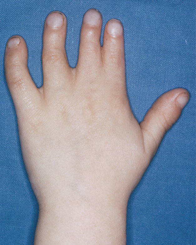 Upper Limb Development 3