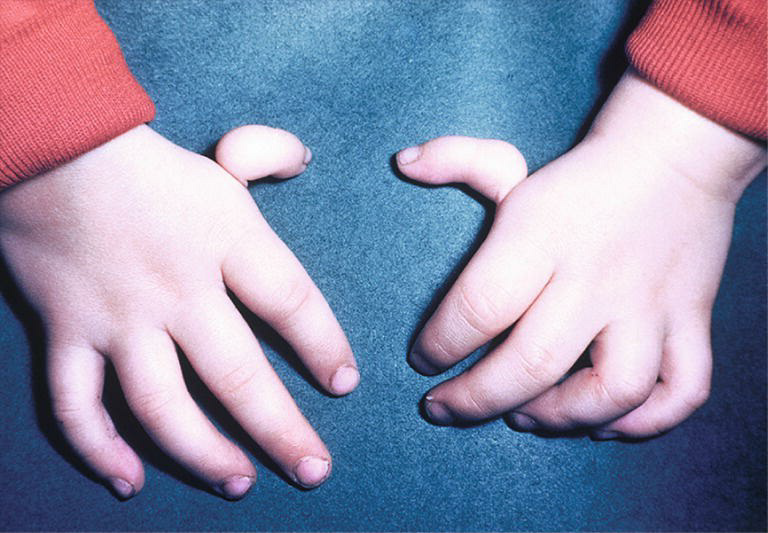 Upper Limb Development 4