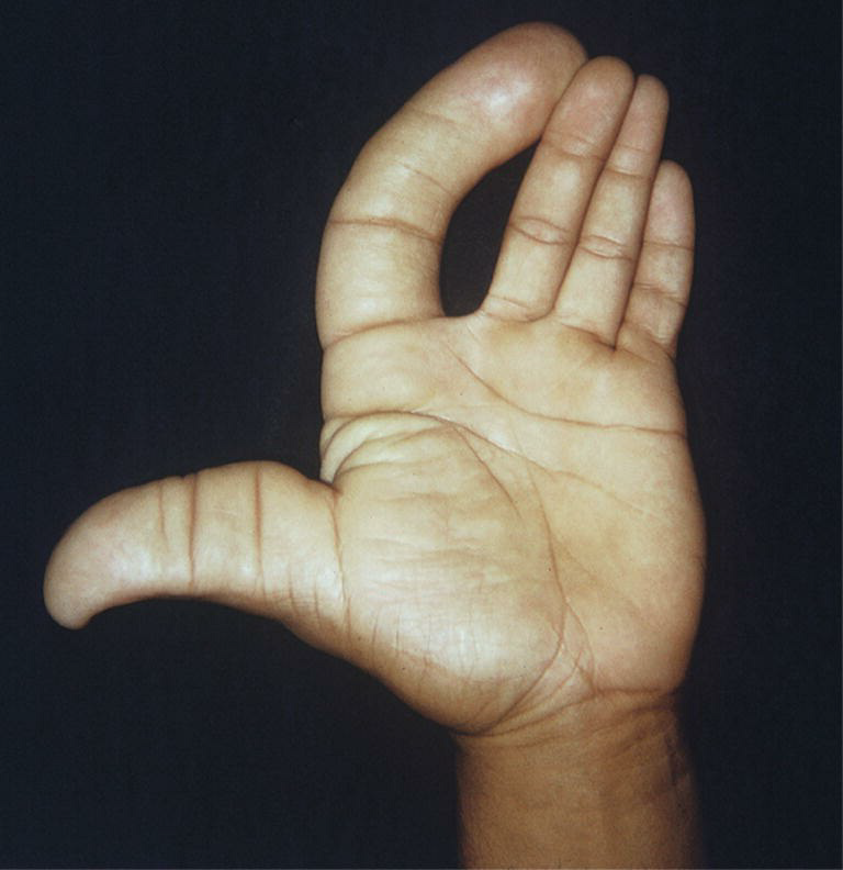 Upper Limb Development 5