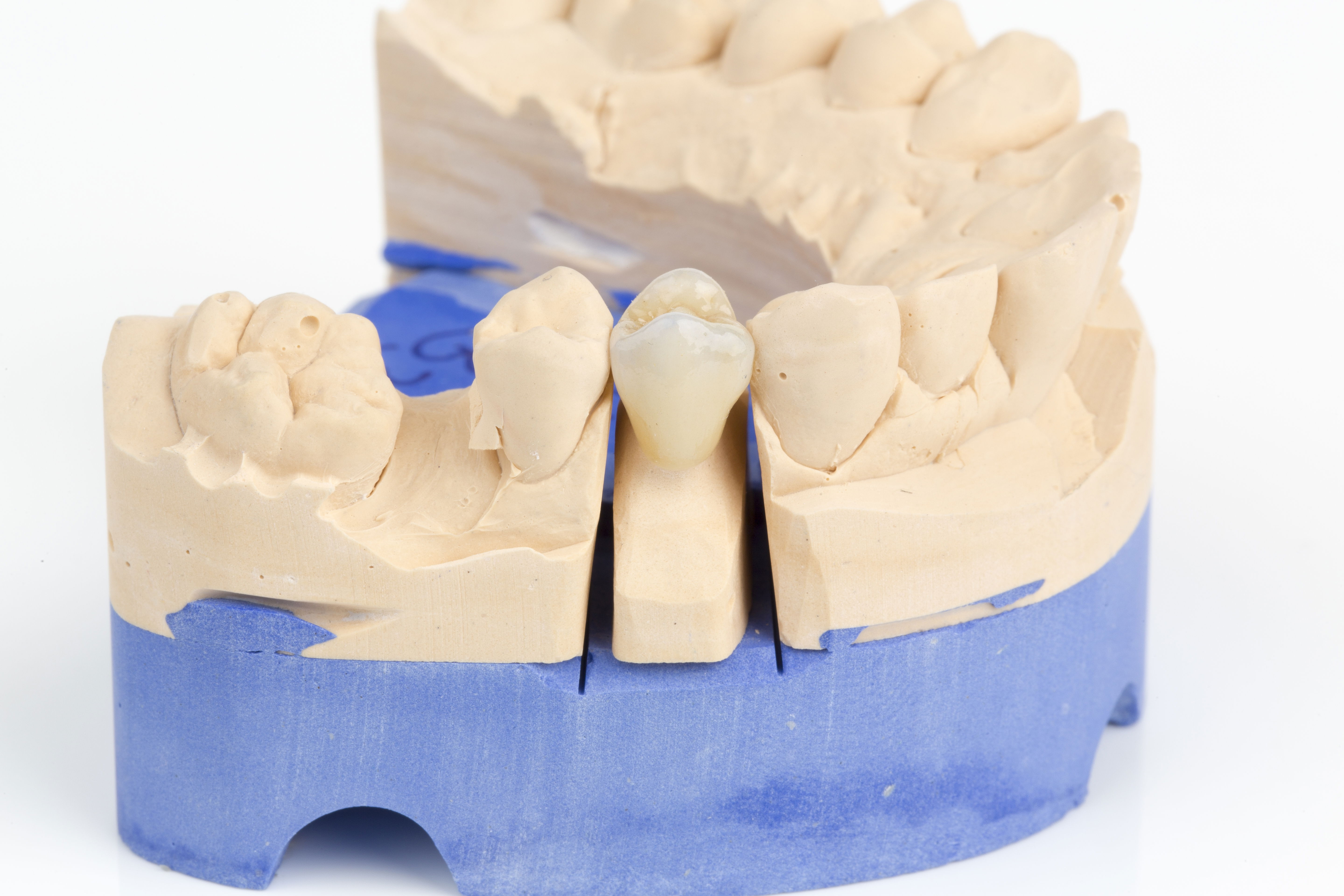 Inlays, Kronen, Brücken