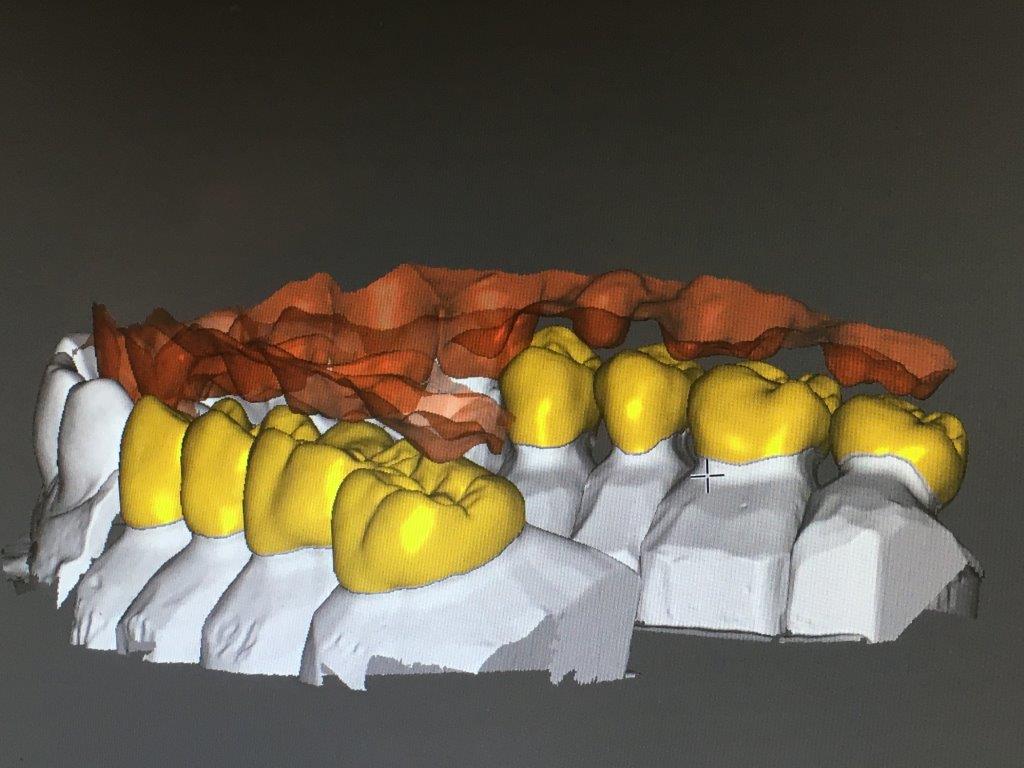 CAD/CAM process