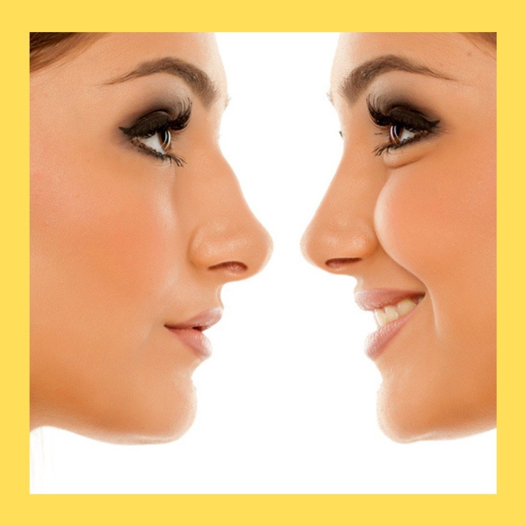 Transforma tu nariz con la rinomodelación de ácido hialurónico. Resultados naturales y personalizados. Descubre la belleza en cada perfil. ¡Consulta ahora!