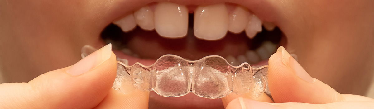 Invisalign Braces, Dental Services