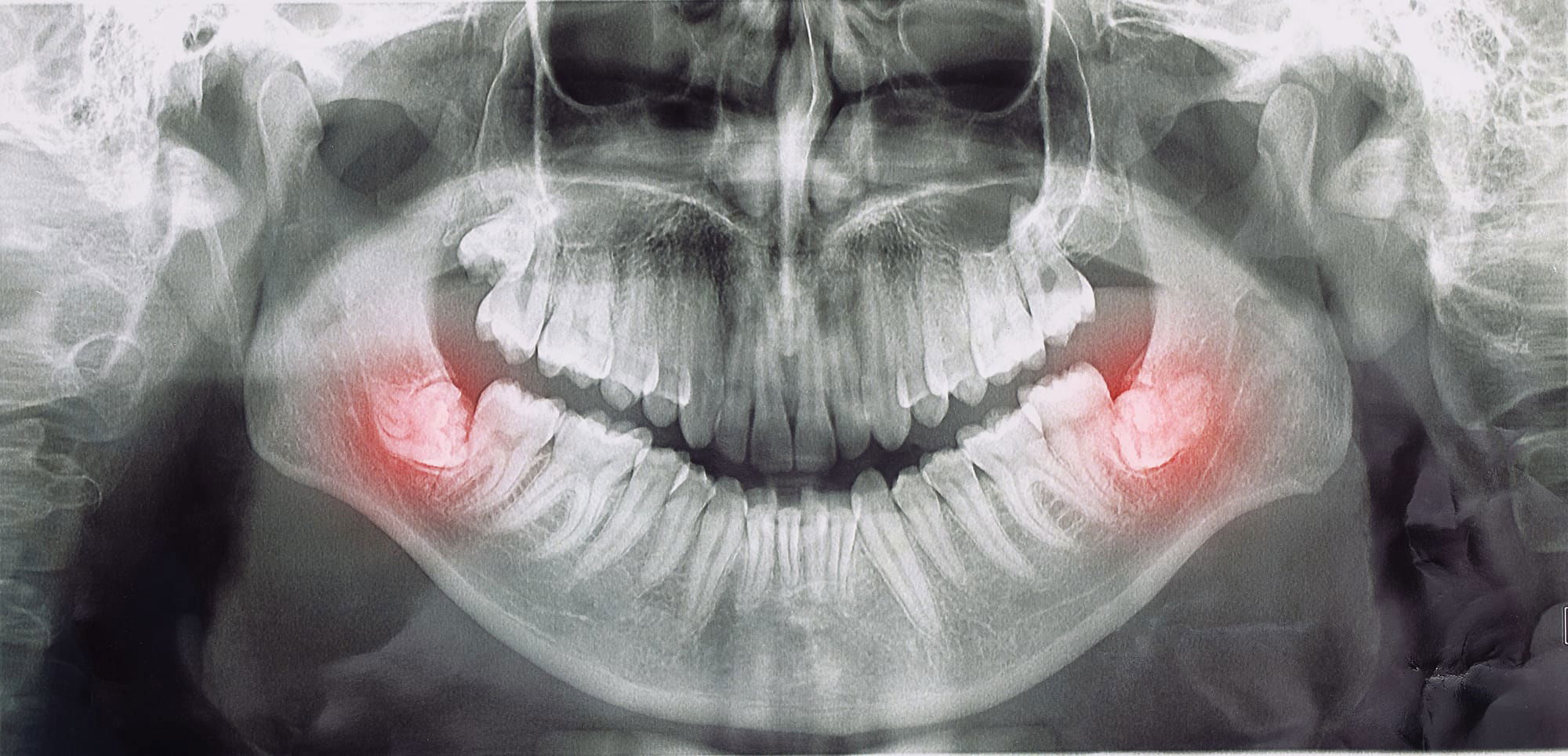 Wisdom Tooth Extractions at Versailles Dental Clinic
