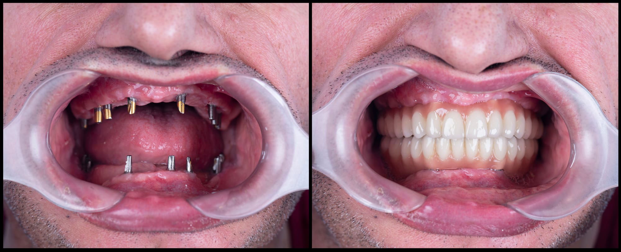 Dental Implants at Versailles Dental Clinic