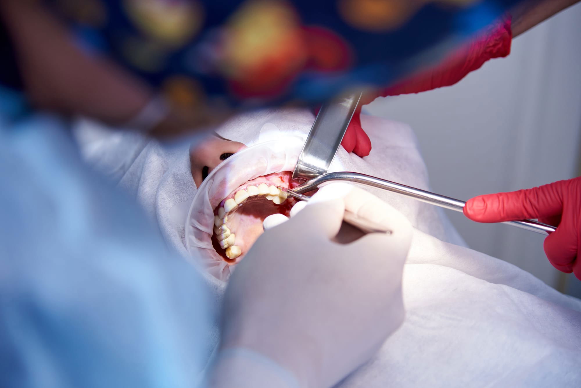 Sinus Lifts at Versailles Dental Clinic