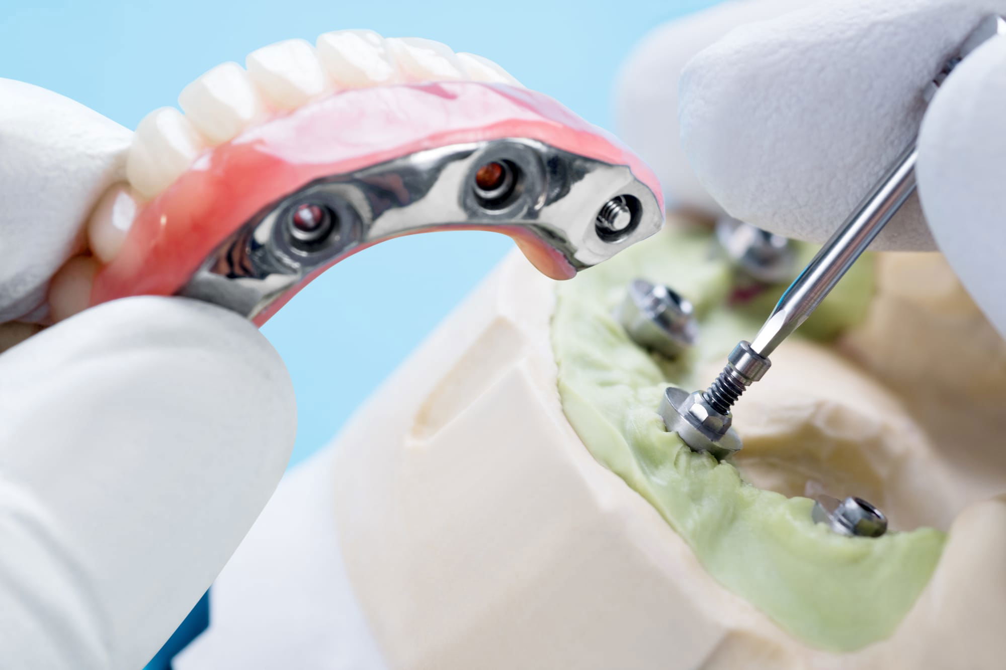 Bridge on Implant at Versailles Dental Clinic